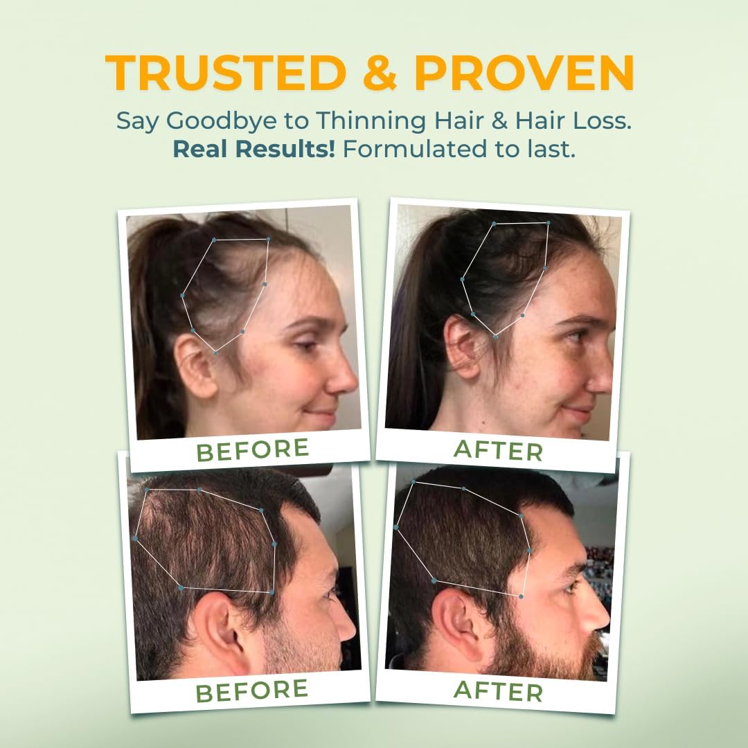 Vital Hair Complex -Hair Growth Vitamins for Women and Men -Biotin & Vitamin B -Hair Growth Supplement for Healthy Hair Skin & Nails -Hormone & Gluten Free -Hair Vitamins for Women - Medaid International