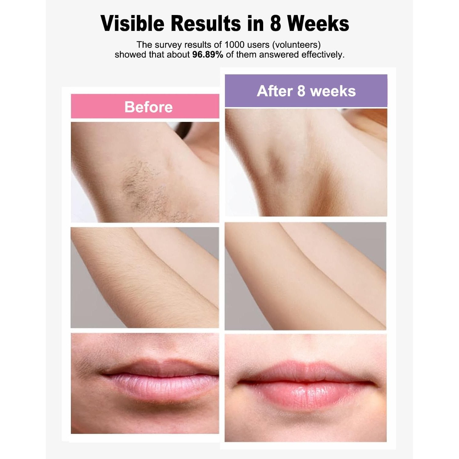 IPL Laser Hair Removal Device Permanent for Women & Men, 999,999 Flashes Safe Effective Lasting Hair Remover, Alternative to Salon, for Face Arms Armpit Legs Bikini Area Whole Body Home Treatment - Medaid International