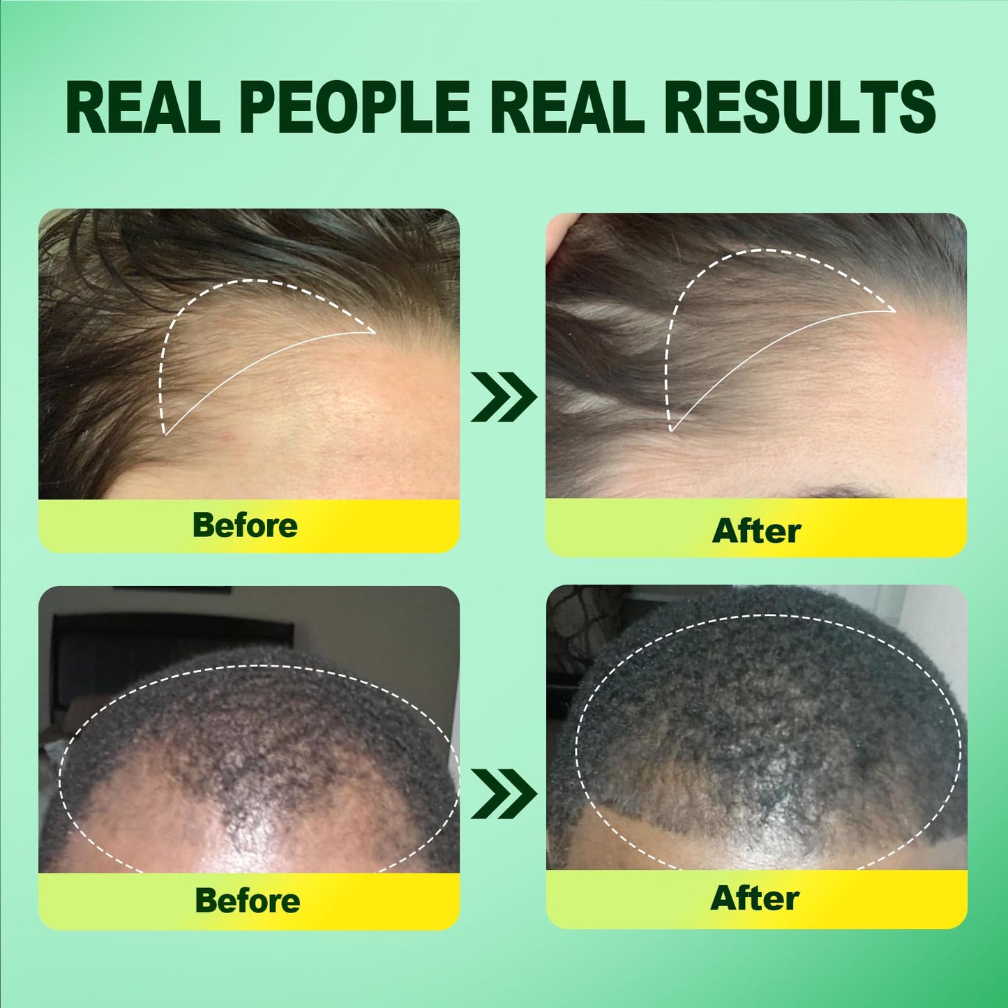 5% Minoxidil for Men, 2PCS Minoxidil for Women Hair Growth Products, Extra Strength Minoxidil Topical Hair Loss Regrowth Treatment Serum with Rosemary & Biotin, Upgraded formula light & Non-Greasy - Medaid International