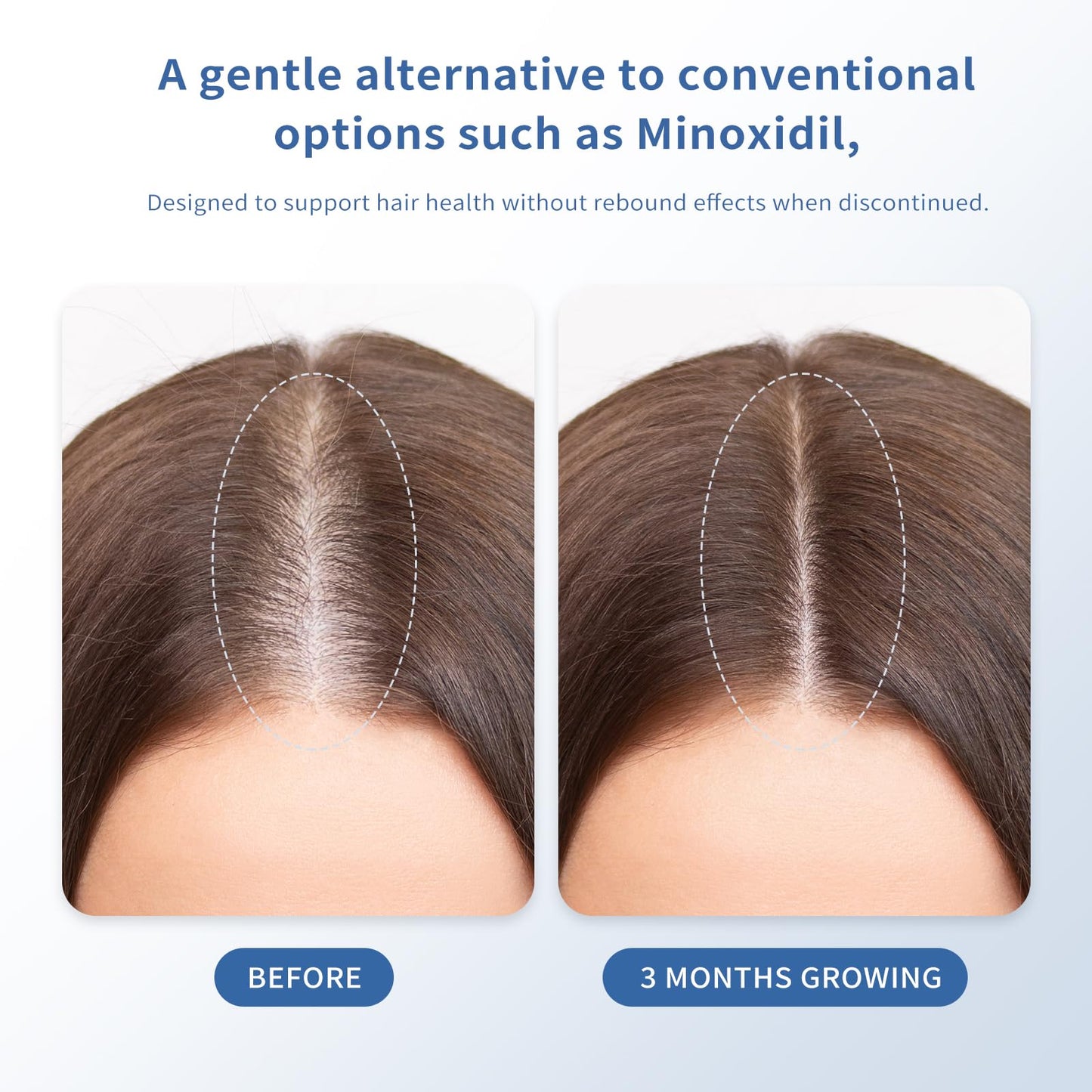 Hair Growth Serum Roll-On 30ml | Patented Blend with 3% Rosemary, 3% Redensyl, 2% AnaGain, Biotin & Niacinamide | No-Rinse, Fast-Absorbing | For Thinning Hair & All Hair Types (1.01 Fl Oz (Pack of 1)) - Medaid International