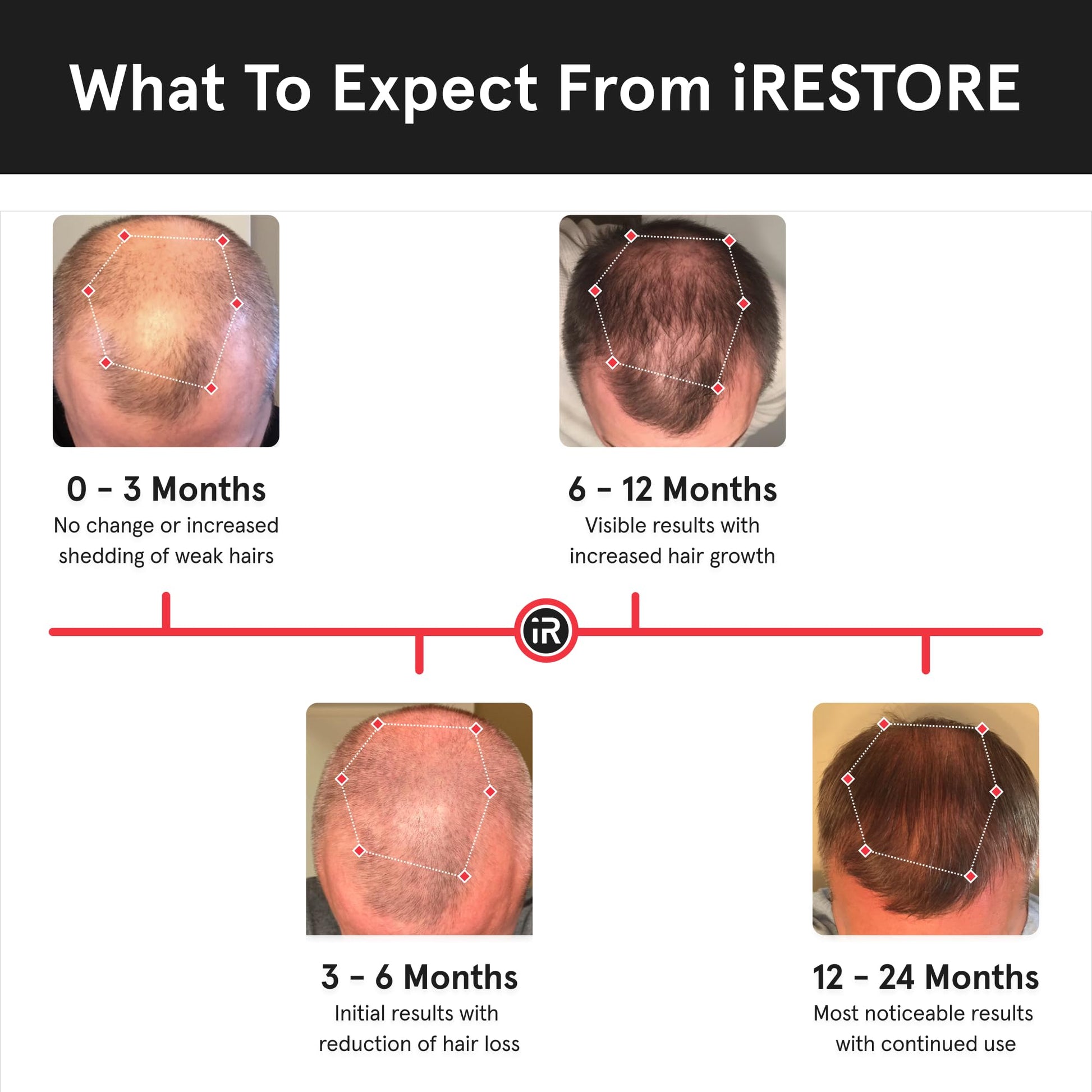 iRestore Essential - Laser Red Light Therapy for Hair Growth - FDA Cleared Hair Loss, Hair Thinning & Alopecia Treatment for Men & Women - Laser Cap for Hair Regrowth Stimulate Denser Fuller Hair - Medaid International