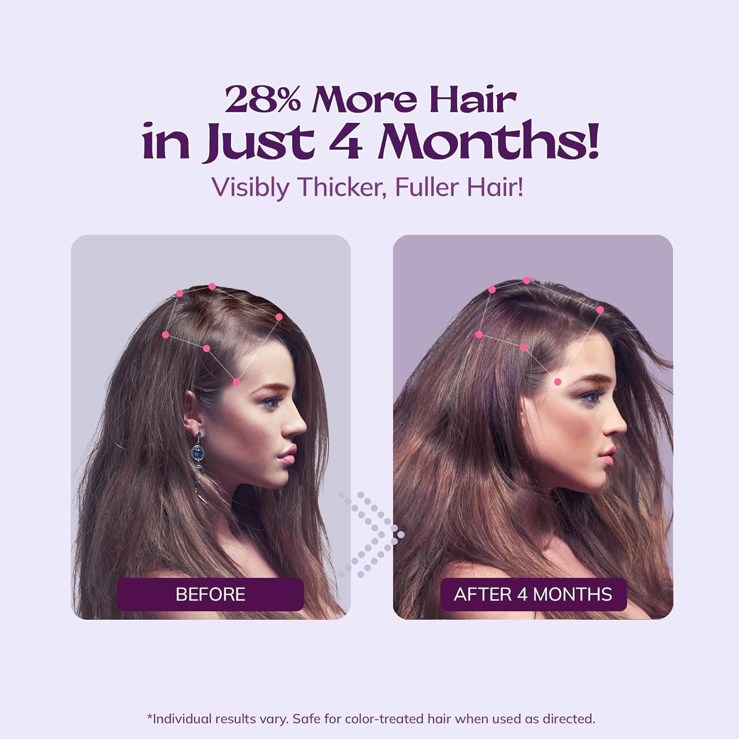 Women's 5% Minoxidil Spray for Hair Growth: RootStim - Medaid International