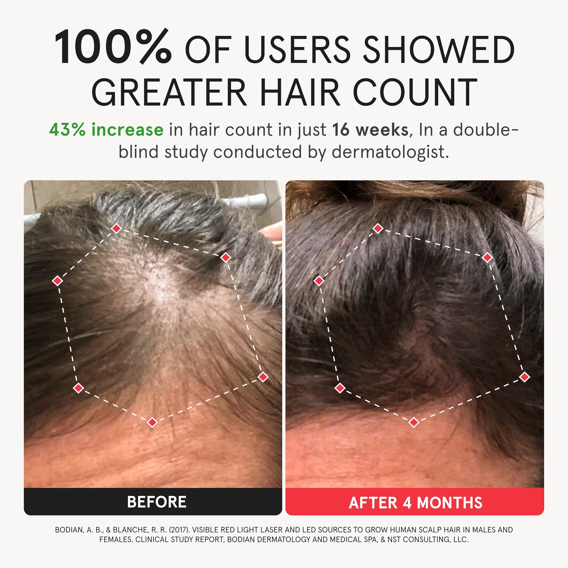 iRestore Elite + Rechargeable Battery Pack - Laser Red Light Therapy for Hair Growth - FDA Cleared Hair Loss, Hair Thinning Treatment for Men & Women - Hair Regrowth Laser Cap - 500 Lasers & LEDs - Medaid International