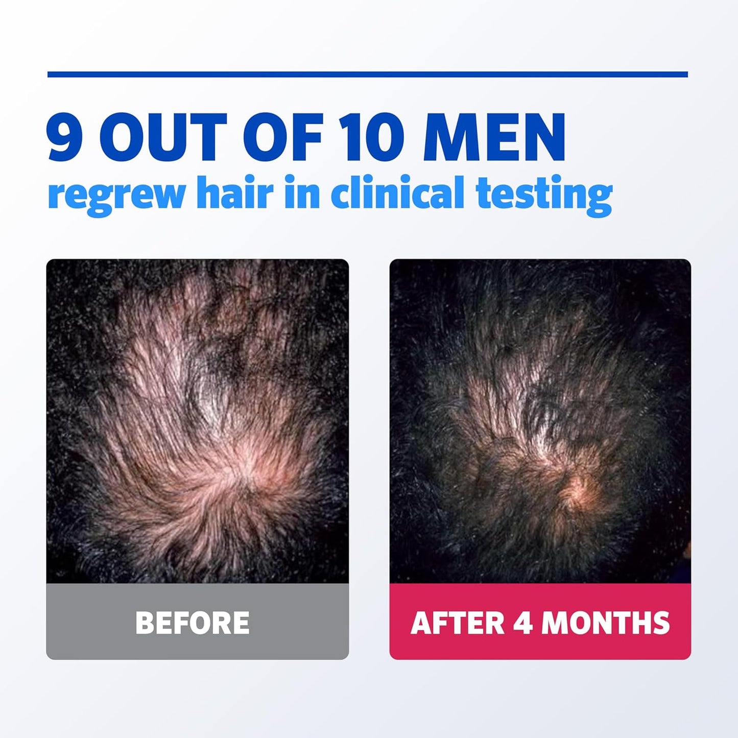 Menās Rogaine 5% Minoxidil for Men Foam, Clinically Proven Regrowth for Thinning Hair, Topical Hair Loss Treatment, Unscented Topical Aerosol, Results in 8ā16 Weeks, 3-Month Supply, 3 x 2.11 oz - Medaid International