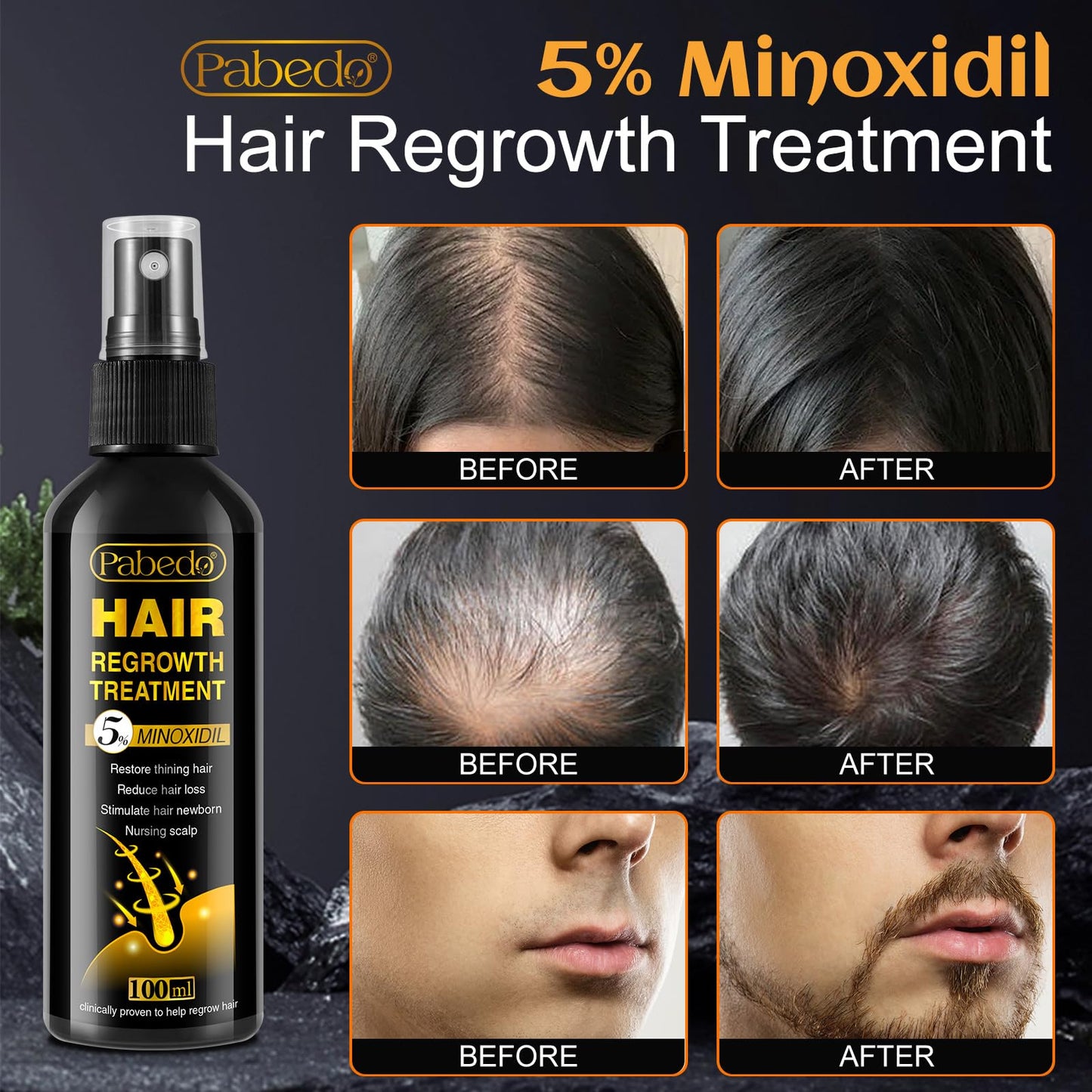 5% Minoxidil for Men and Women Hair Growth Serum - Castor Oil & Biotin Hair Growth Spray Hair Regrowth Treatment for Scalp Hair Loss Hair Thinning For Thicker Longer Fuller Healthier Hair 100Ml - Medaid International