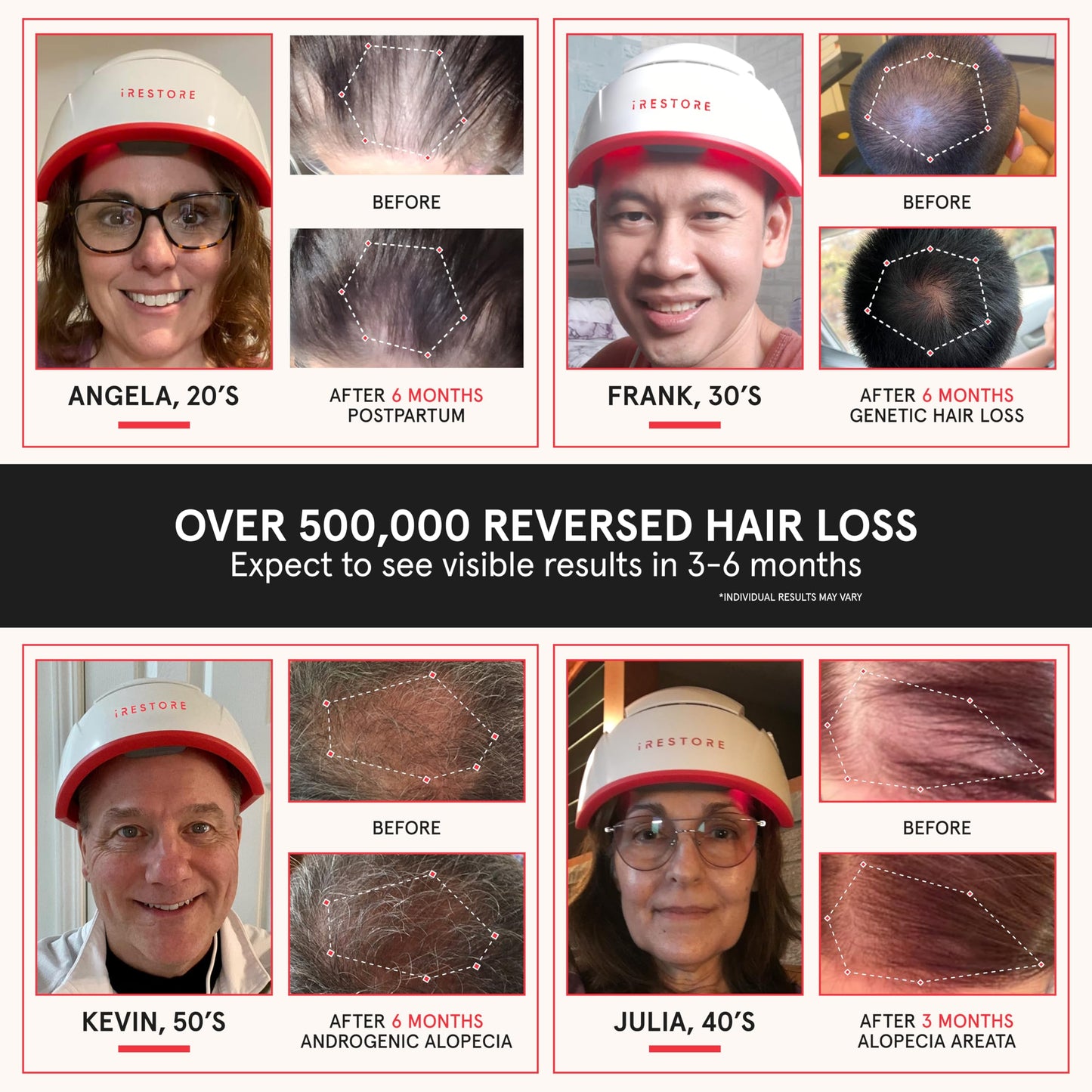 iRestore Professional Laser Red Light Therapy for Hair Growth System - FDA Cleared Hair Loss, Hair Thinning & Alopecia Treatment for Men & Women - 282 Lasers & LEDs - Medaid International