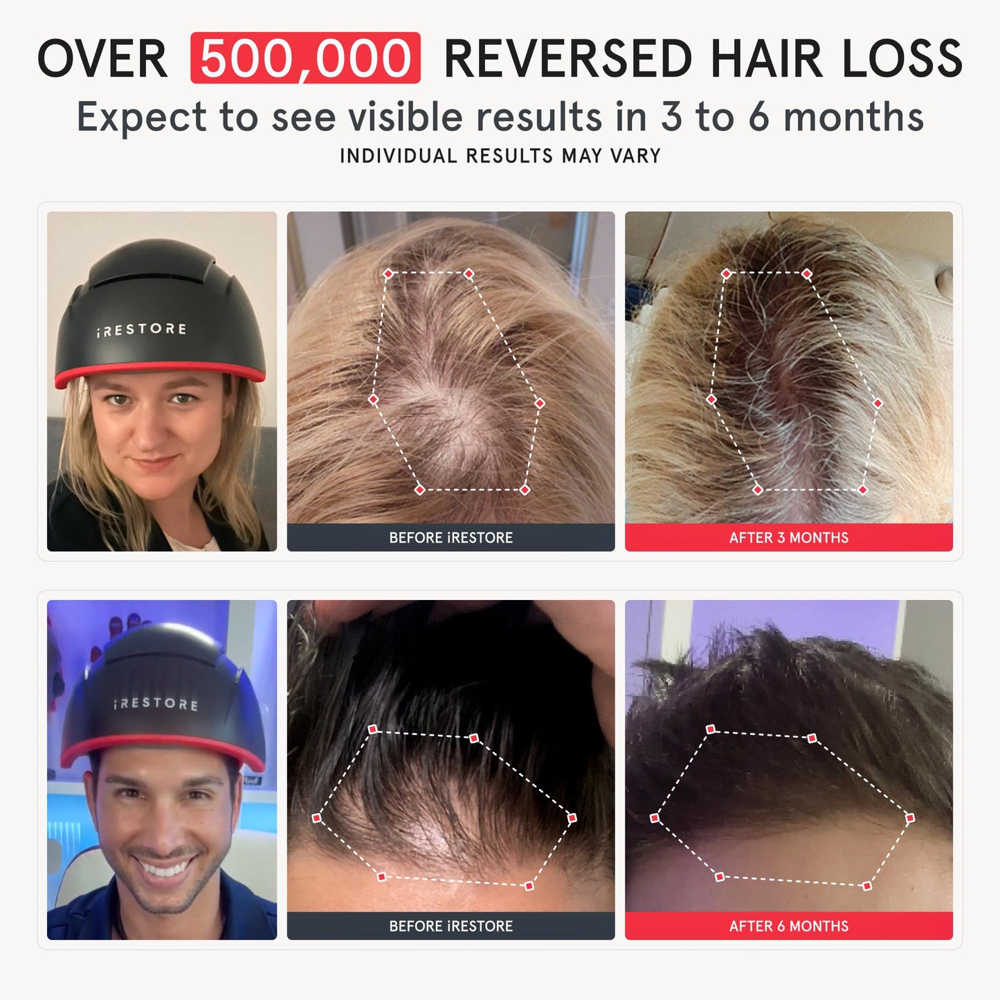 iRestore Elite - Laser Red Light Therapy for Hair Growth System - FDA Cleared Hair Loss, Hair Thinning & Alopecia Treatment for Men & Women - Laser Cap for Hair Regrowth Stimulates Denser Fuller Hair - Medaid International
