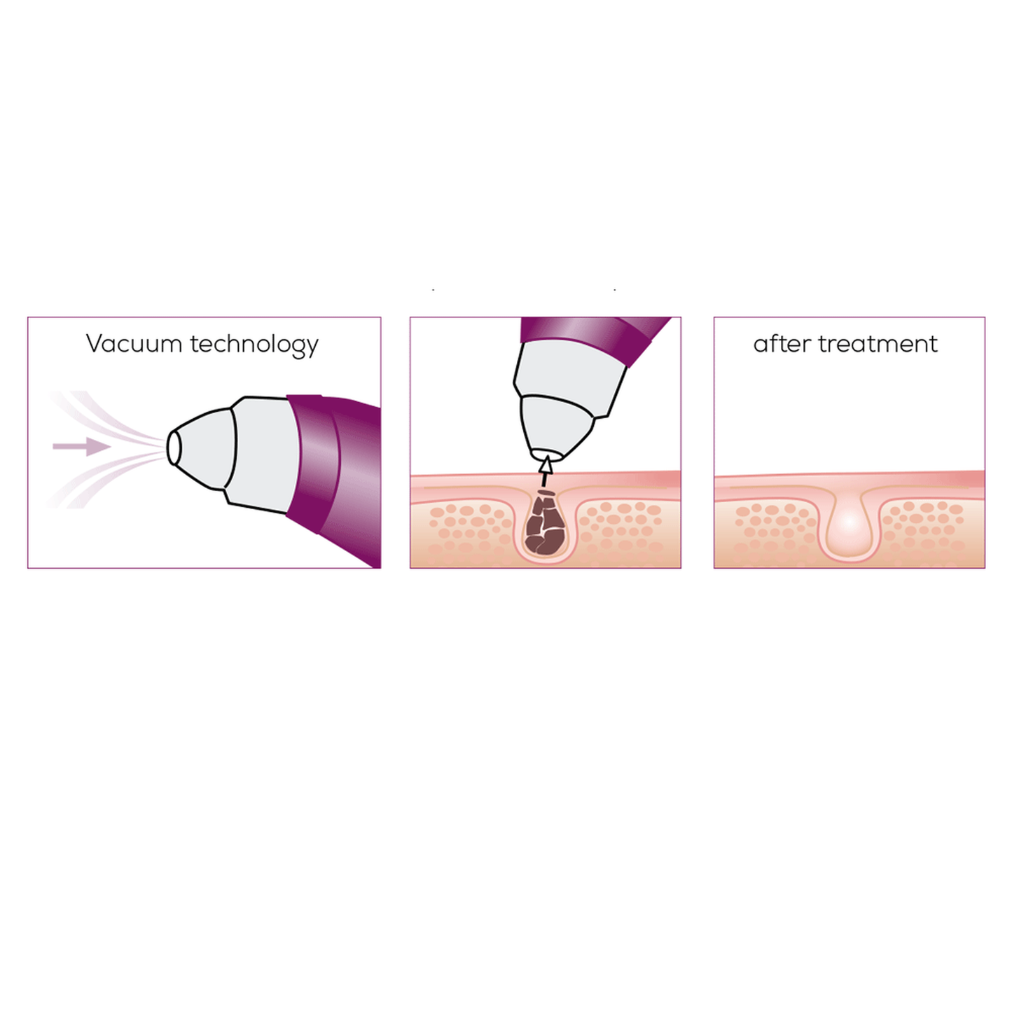 Beurer FC 41 Power Deep Pore Cleanser - Medaid International