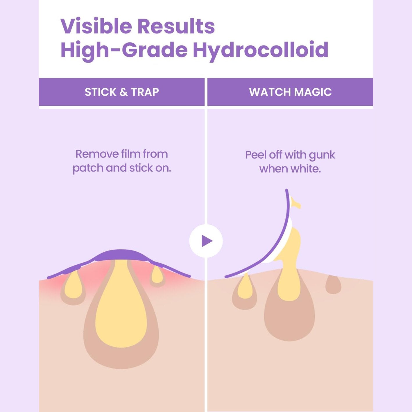 GLAM UP Spotless Patch - Hydrocolloid Spot Patch for Wide Acne area, Cheek, Body, Blackhead Cruelty Free and Vegan Friendly (12 Count) - Medaid International