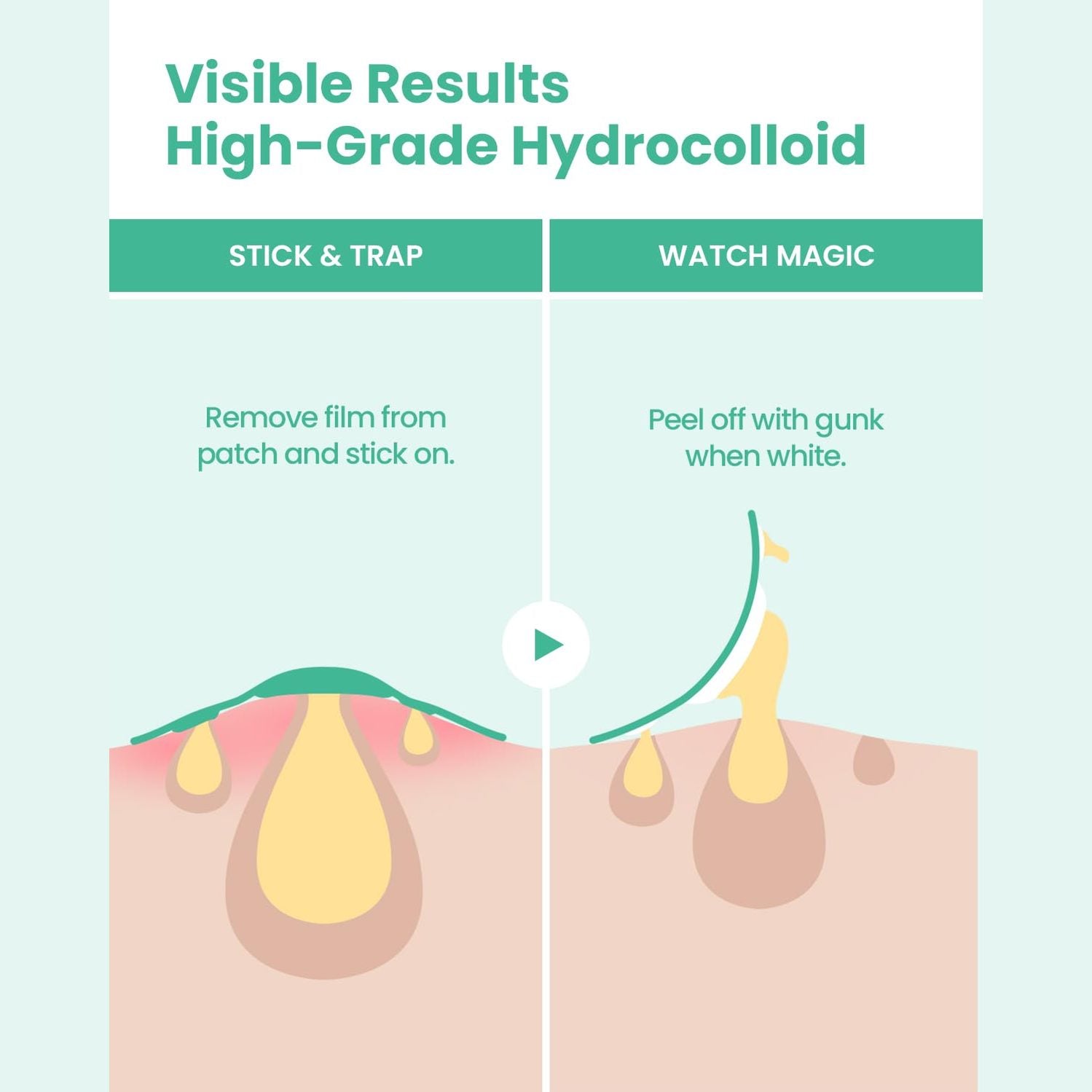 GLAM UP Spotless Nose Patch Hydrocolloid Coverage for Nose Pores, Zits and Oil - Overnight Strong Waterproof to Absorb Blackheads & Pimple Nose Gunk, and Calm with Tea Tree (12 Patches) - Medaid International