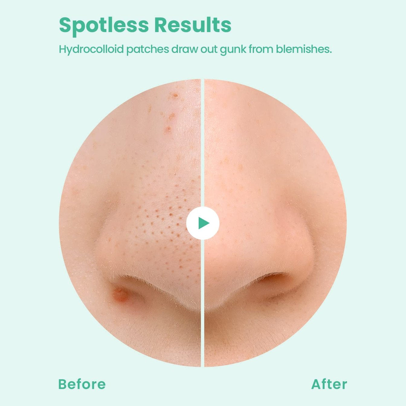 GLAM UP Spotless Nose Patch Hydrocolloid Coverage for Nose Pores, Zits and Oil - Overnight Strong Waterproof to Absorb Blackheads & Pimple Nose Gunk, and Calm with Tea Tree (12 Patches) - Medaid International