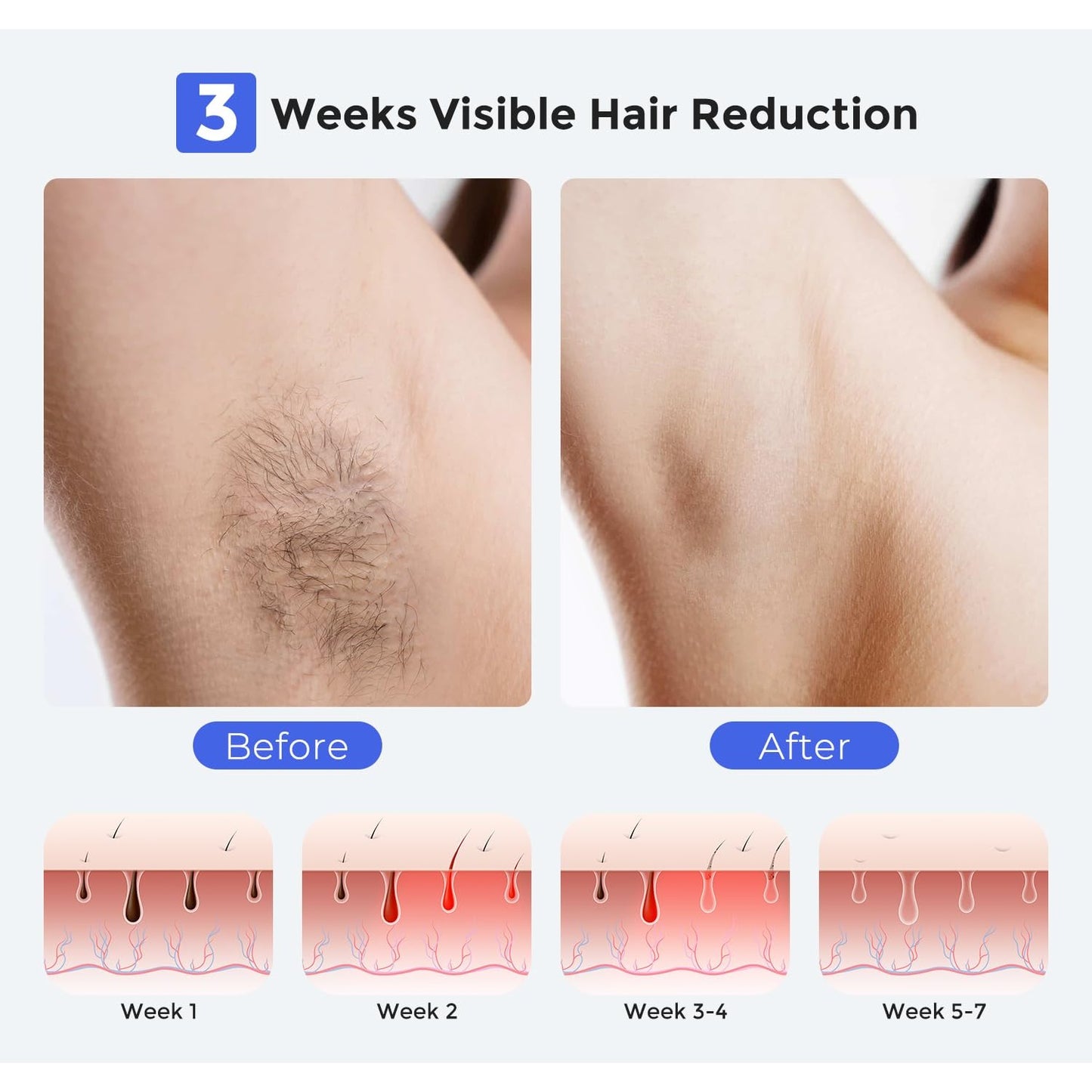 LUBEX Smart Permanent IPL Laser Hair Removal for Woman and Men, Painless Sapphire Ice-Cooling, Alternative to Salon, Bikini Shaver, Facial Epilator for Armpits Back Legs Arms Face Bikini Glow 6 A+ - Medaid International