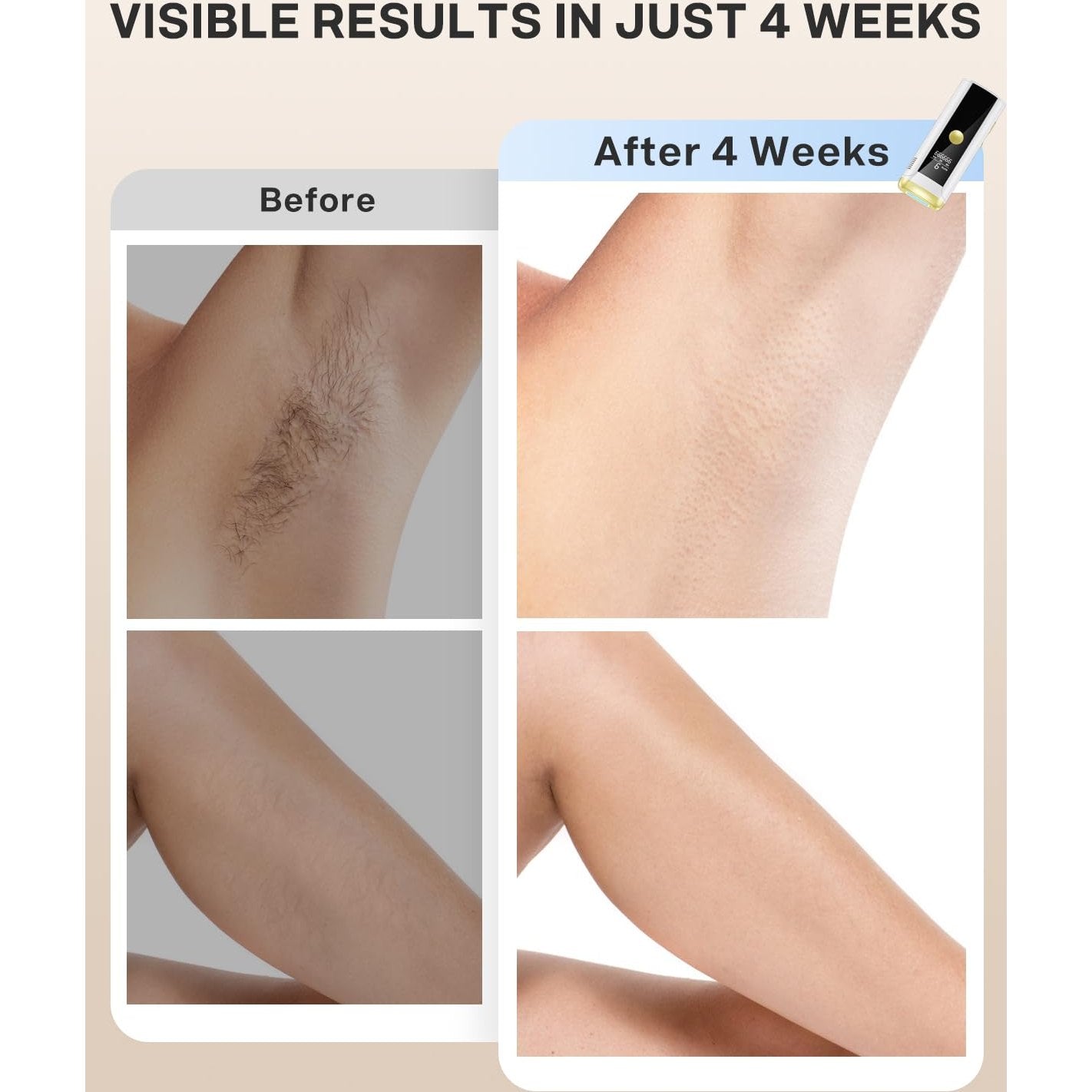 Hair Removal for Women and Men, At Home IPL Hair Removal Device with 3 Modes, Permanent Hair Remover Machine for Facial Legs Arms Bikini Line Whole Body Depilation, Come with Razor & Glasses - Medaid International