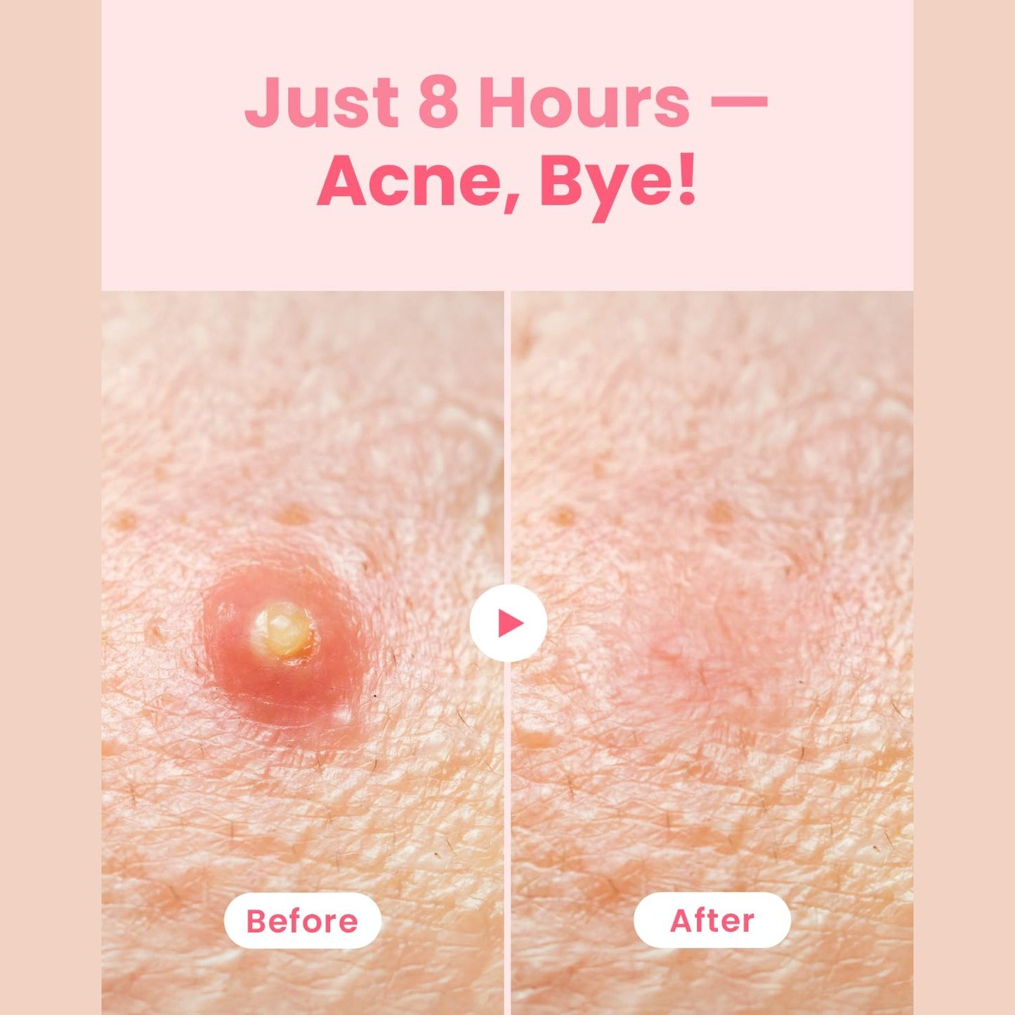 GLAM UP Hydrocolloid Blemish Pimple Zit Patches - Invisible Ultra Thin Spot Cover Stickers for Face and Skin, Strong Water-proof and Adhesive Overnight, Vegan-friendly (36 Count / 2 Sizes) - Medaid International