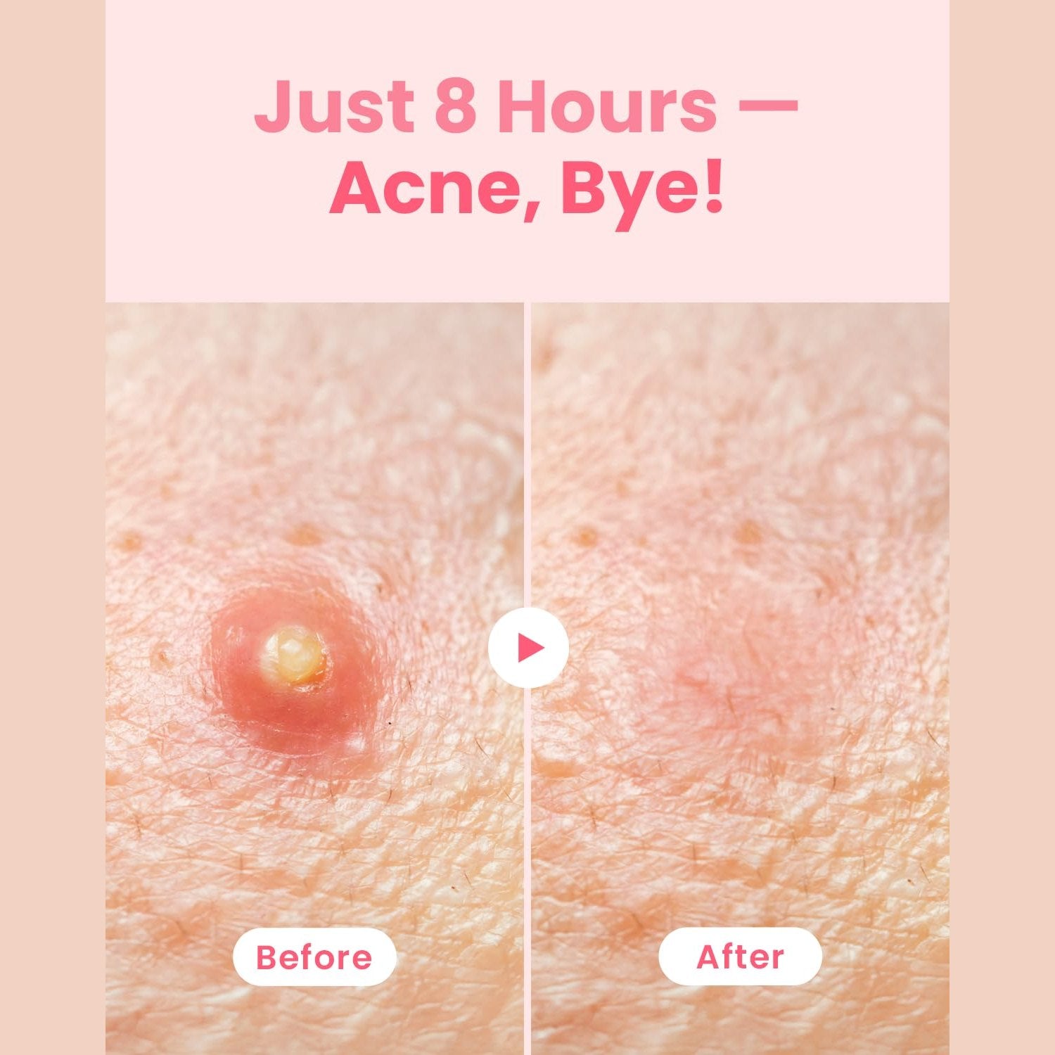 GLAM UP Hydrocolloid Blemish Pimple Zit Patches - Invisible Ultra Thin Spot Cover Stickers for Face and Skin, Strong Water-proof and Adhesive Overnight, Vegan-friendly (36 Count / 2 Sizes) - Medaid International