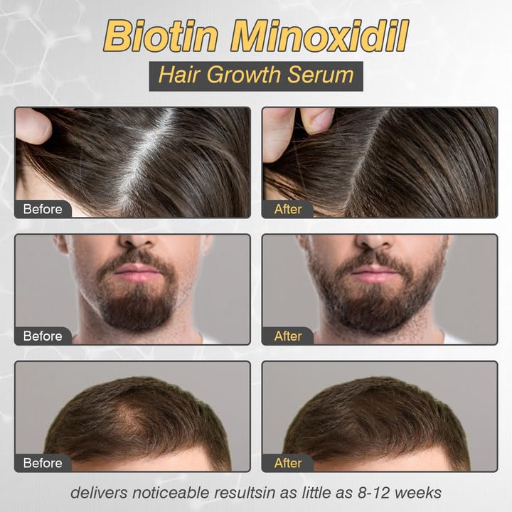 5% Minoxidil Hair Growth for Men and Women, Minoxidil Hair Growth Serum, Promotes Hair Growth, Strengthens Hair Follicles, Helps Prevent Hair Fall and Hair Loss - Medaid International
