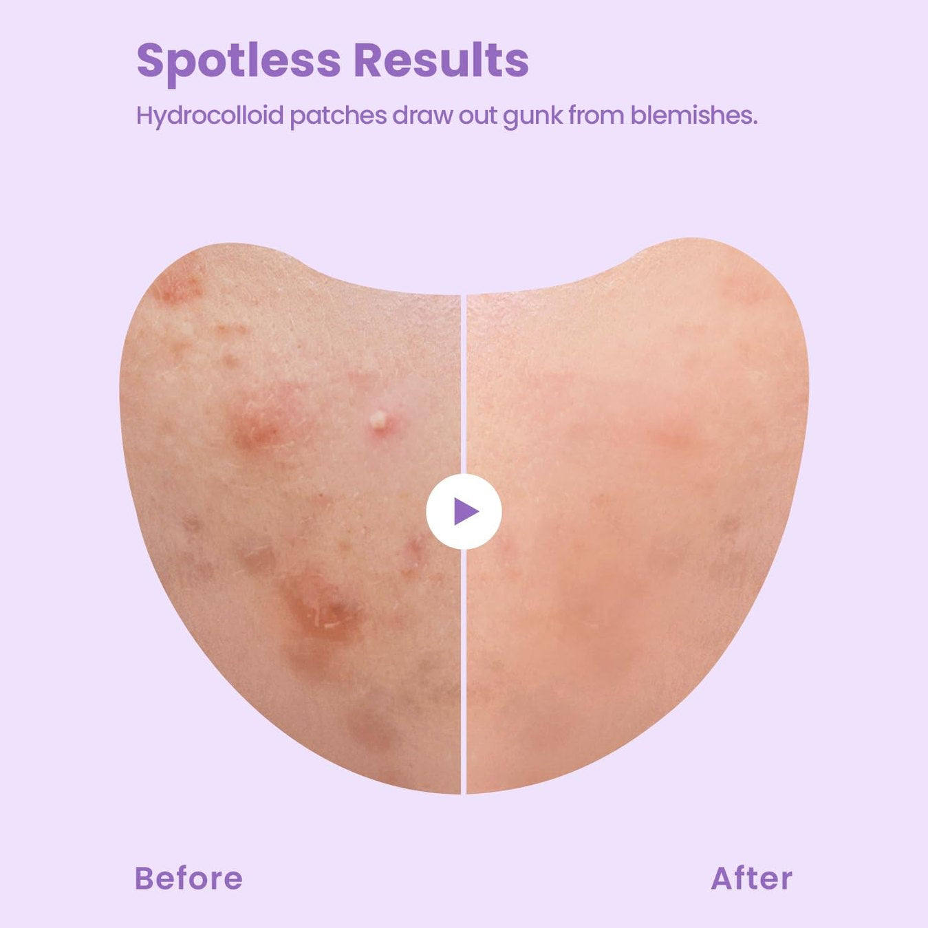 GLAM UP Spotless Patch - Hydrocolloid Spot Patch for Wide Acne area, Cheek, Body, Blackhead Cruelty Free and Vegan Friendly (12 Count) - Medaid International