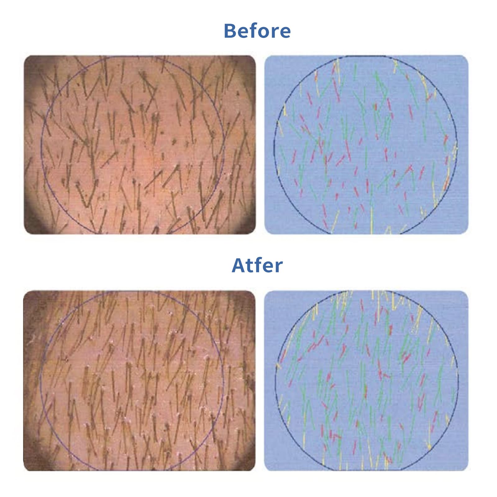 Hair Growth Serum Roll-On 30ml | Patented Blend with 3% Rosemary, 3% Redensyl, 2% AnaGain, Biotin & Niacinamide | No-Rinse, Fast-Absorbing | For Thinning Hair & All Hair Types (1.01 Fl Oz (Pack of 1)) - Medaid International