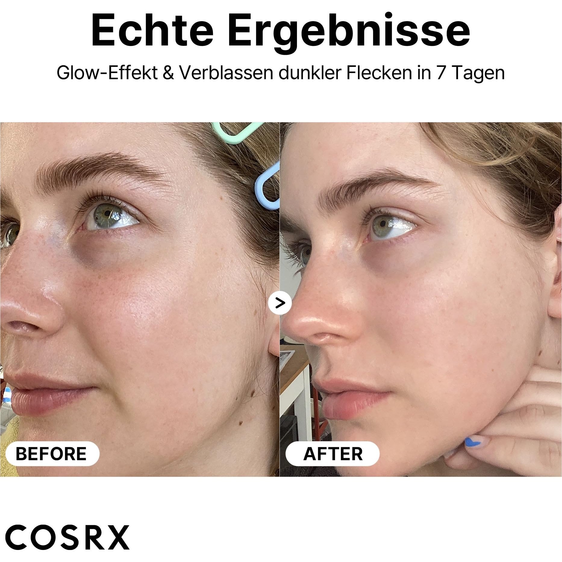 COSRX Pure Vitamin C 23% Serum with Vitamin E & Hyaluronic Acid, Hydrating Facial Serum for Fine Lines, Uneven Skin Tone & Dull Skin, 0.7oz/20g, Korean Skin Care - Medaid International