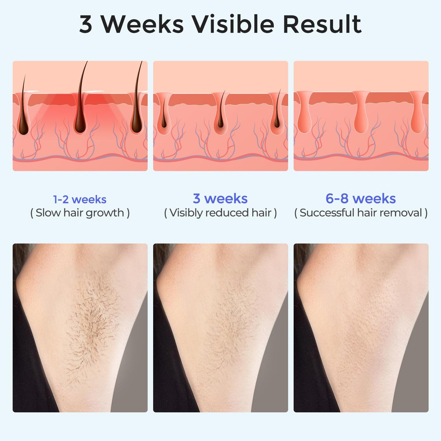 Laser Hair Removal Women and Men, Sapphire Ice-Cooling Contact IPL Hair Removal, Painless and Permanent, Alternative to Salon, Hair Removal Device for Armpits, Legs, Bikini, Face - Medaid International