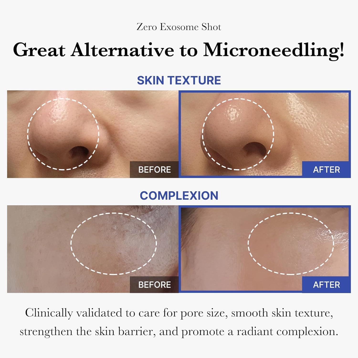 medicube Zero Exosome Shot 2,000 PPM Spicule Facial Serum | Liquid Skin Booster Serum | Exosome, AHA+BHA+PHA | Pore Care, Dead Skin Cells, Skin Texture | Korean Skin Care 1.01 fl.oz - Medaid International