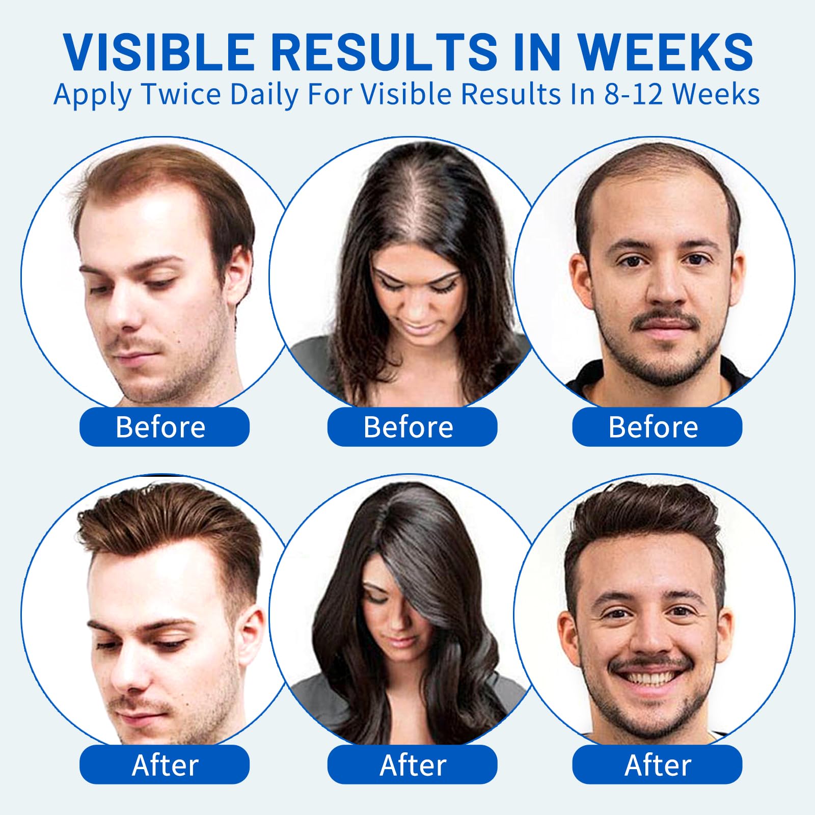 5% Minoxidil Hair Growth Foam for Men & Women – 2 Pack (60ml Each) | Extra Strength Hair Regrowth Treatment with Biotin | Supports Thicker, Fuller-Looking Hair - Medaid International