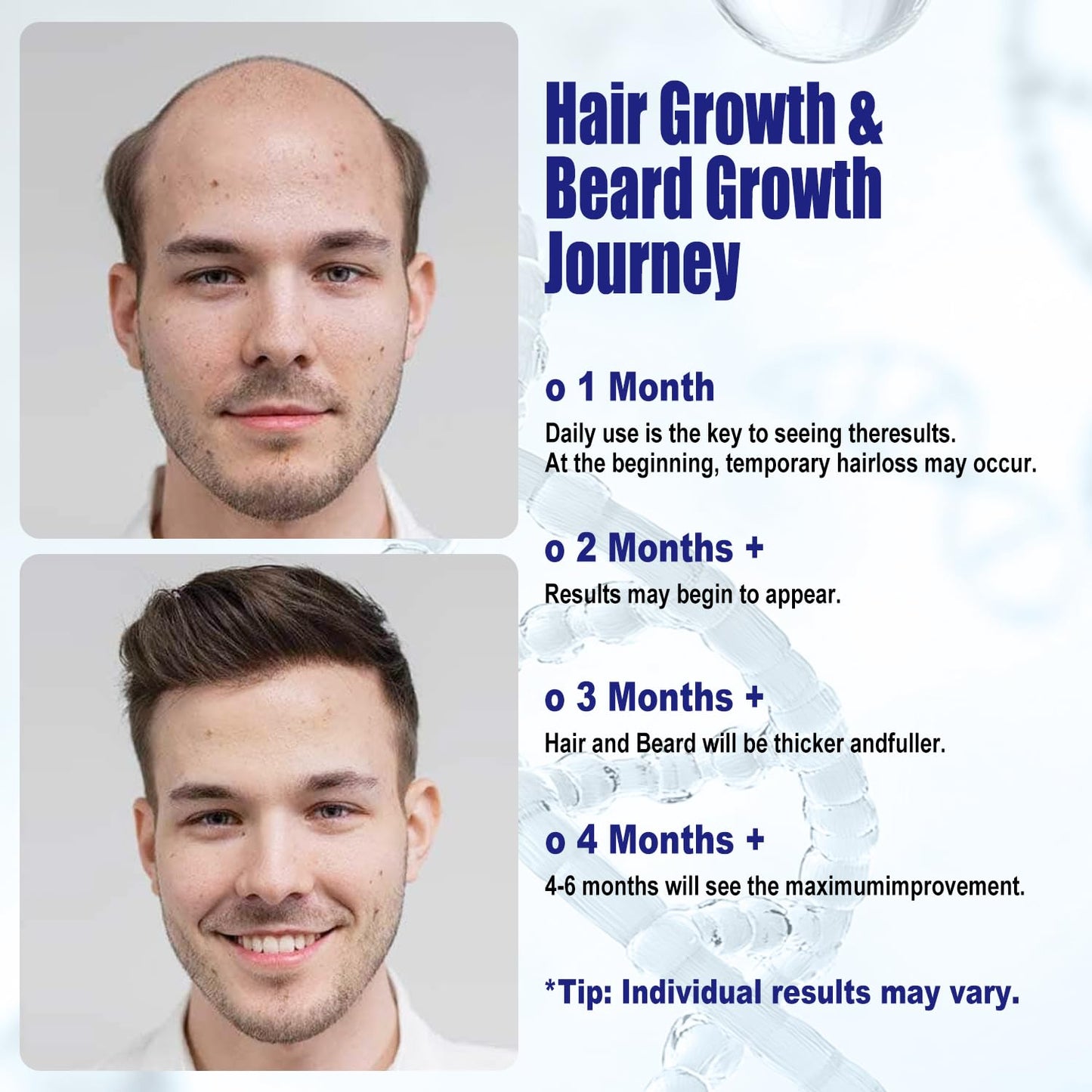 5% Minoxidil For Men And Women Hair Growth Spray - Hims Hair Regrowth Treatment For Stronger Thicker Longer Hair 2-3 Month Supply 100ml(3.38oz) - Medaid International