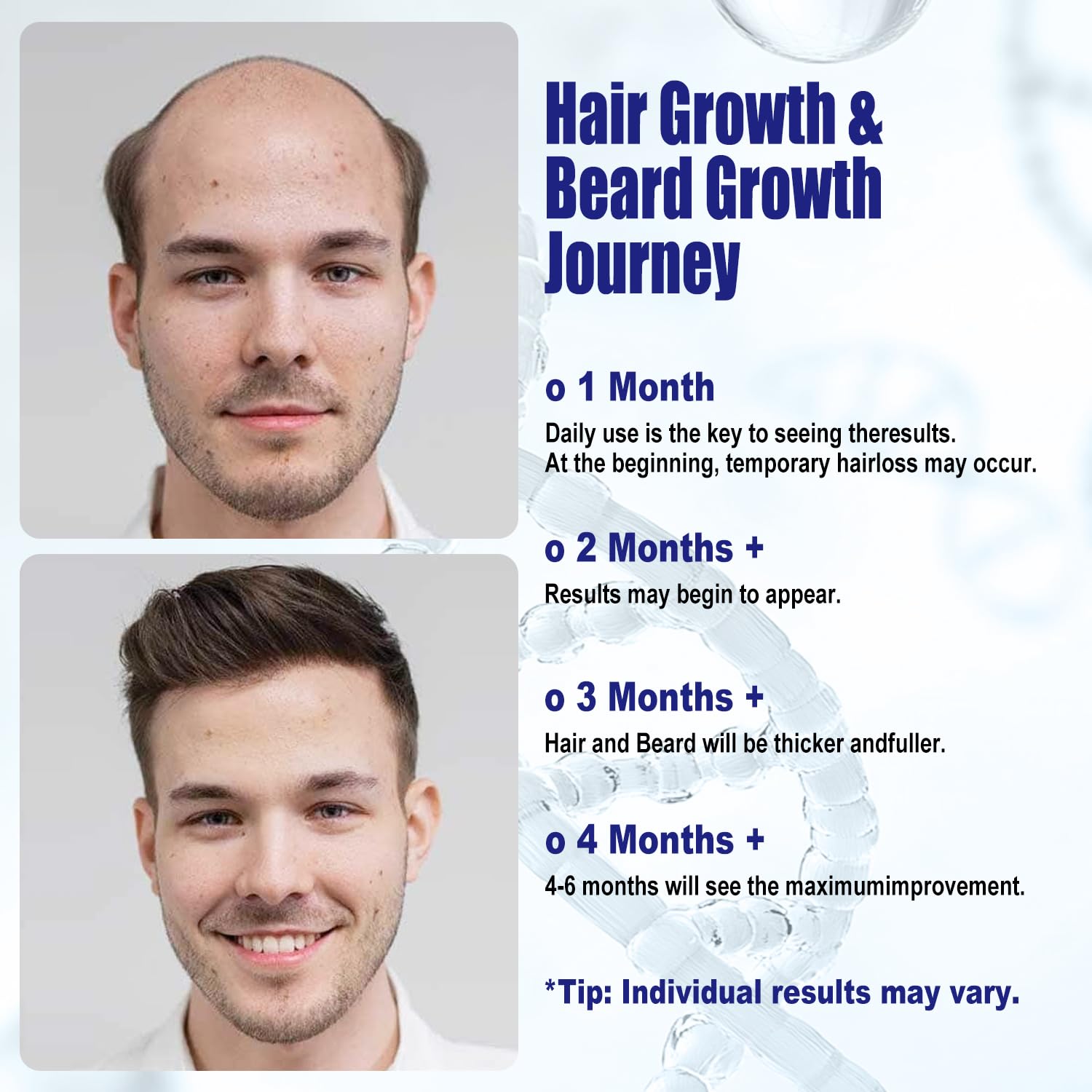 5% Minoxidil For Men And Women Hair Growth Spray - Hims Hair Regrowth Treatment For Stronger Thicker Longer Hair 2-3 Month Supply 100ml(3.38oz) - Medaid International