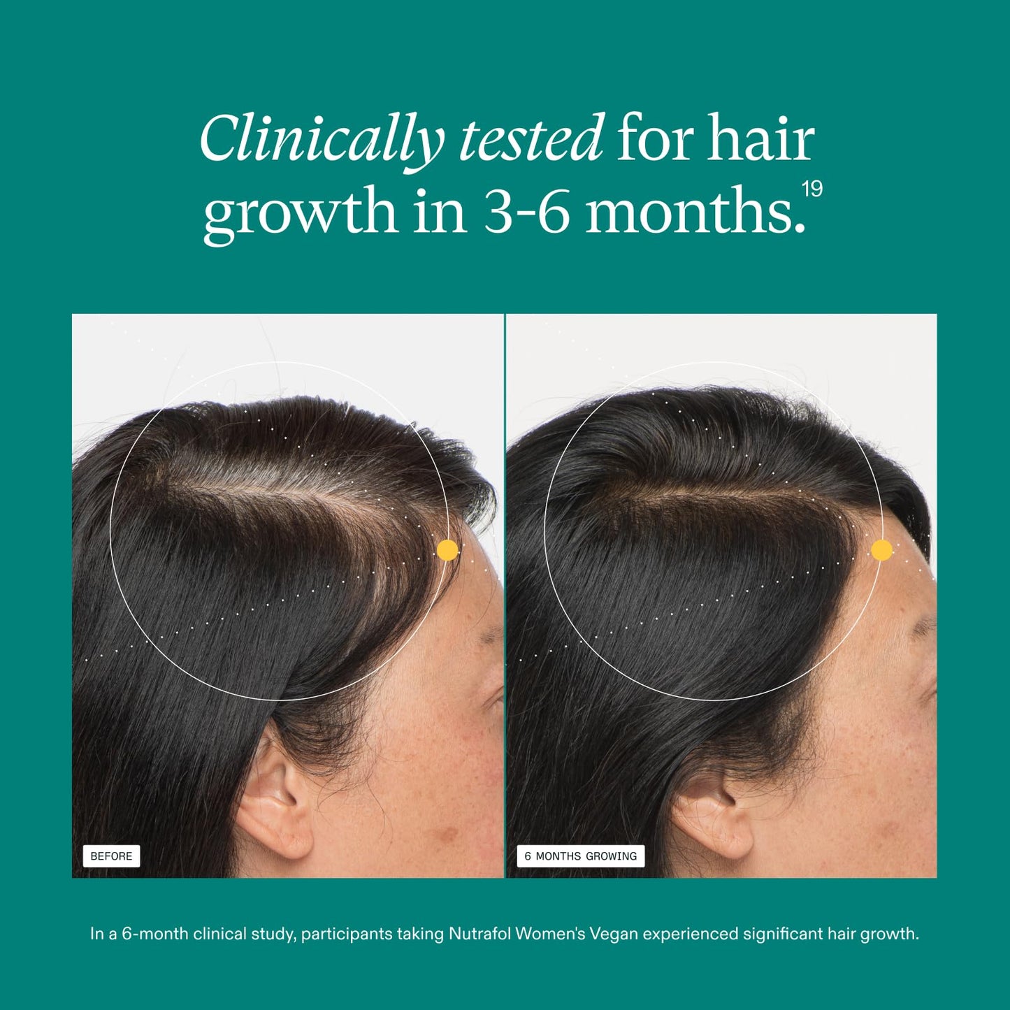 Nutrafol Women's Hair Growth Supplements, For Women 18-44 Years Old, Clinically Tested for Visibly Thicker, Stronger Hair, 100% Vegan Ingredients, Dermatologist Recommended - 1 Month Supply - Medaid International