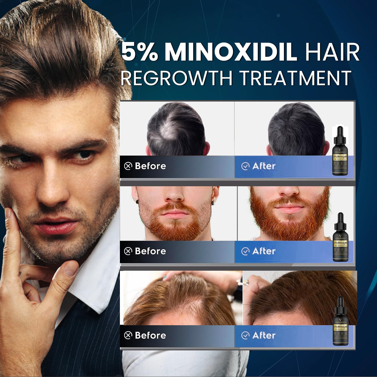 5% Minoxidil Hair Growth for Men and Women: Biotin Hair Growth Serum for Hair Loss, Thinning, and Faster Regrowth Treatment - 60ML - Medaid International