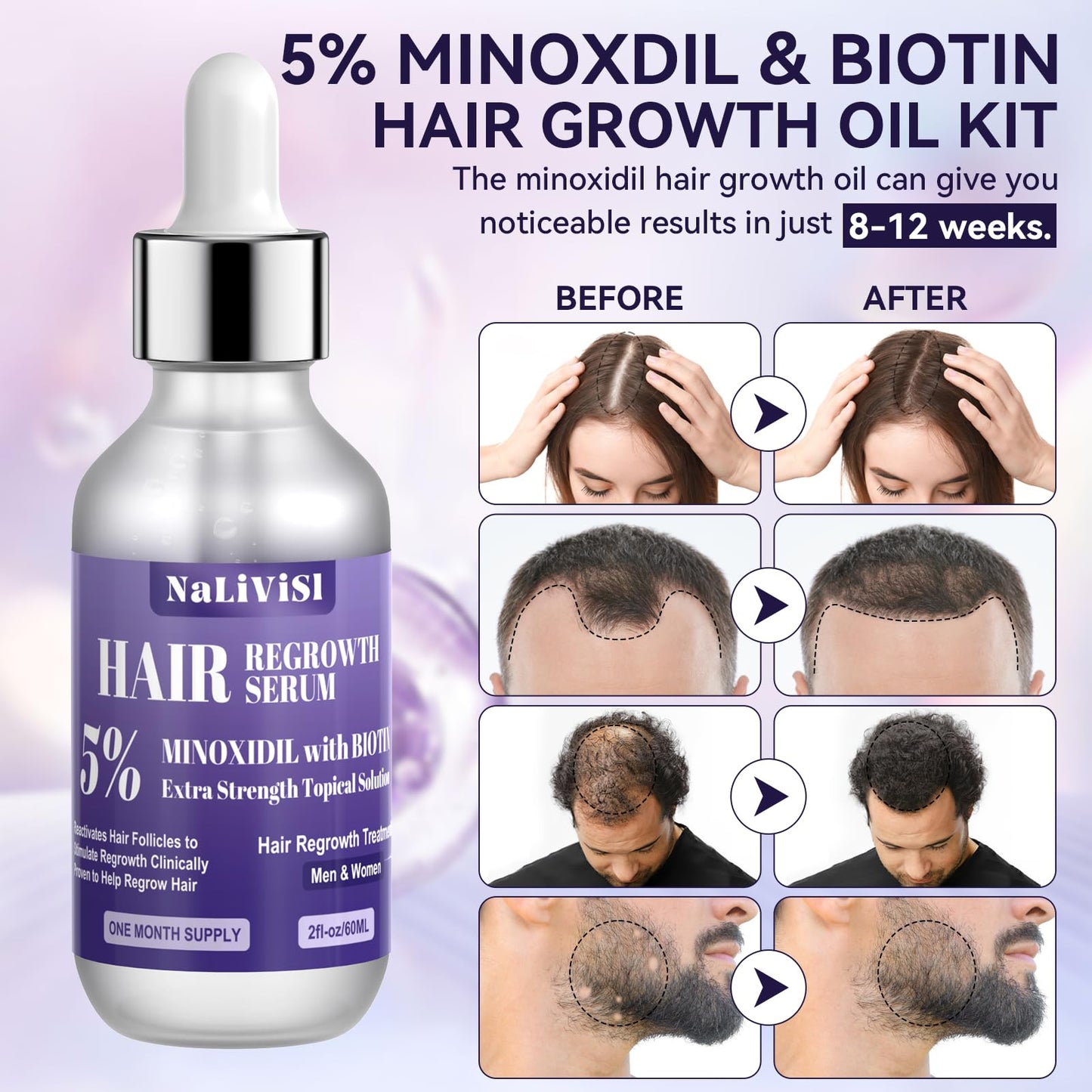 2 Pack 5% Minoxidil for Men Women Hair Growth Oil Regrowth Serum with Scalp Massager, Extra Strength Hair Loss Treatments Spray Foam, Beard Growth Kit - Hair Growth Products, - Medaid International