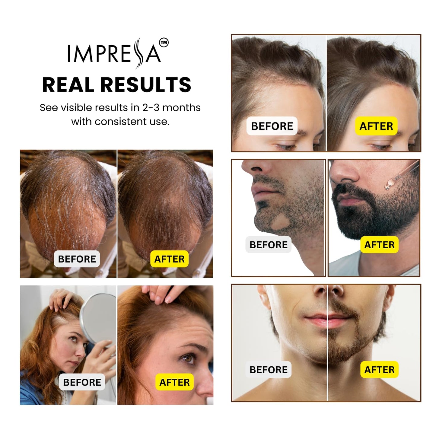 IMPRESSA Hair Growth Kit, 5% Minoxidil with Biotin and Natural Oil, Hair Regrowth for Men and Women, Hair Loss Treatments, Scalp Massager, 1.7 Fl Oz, Unisex Adult - Medaid International