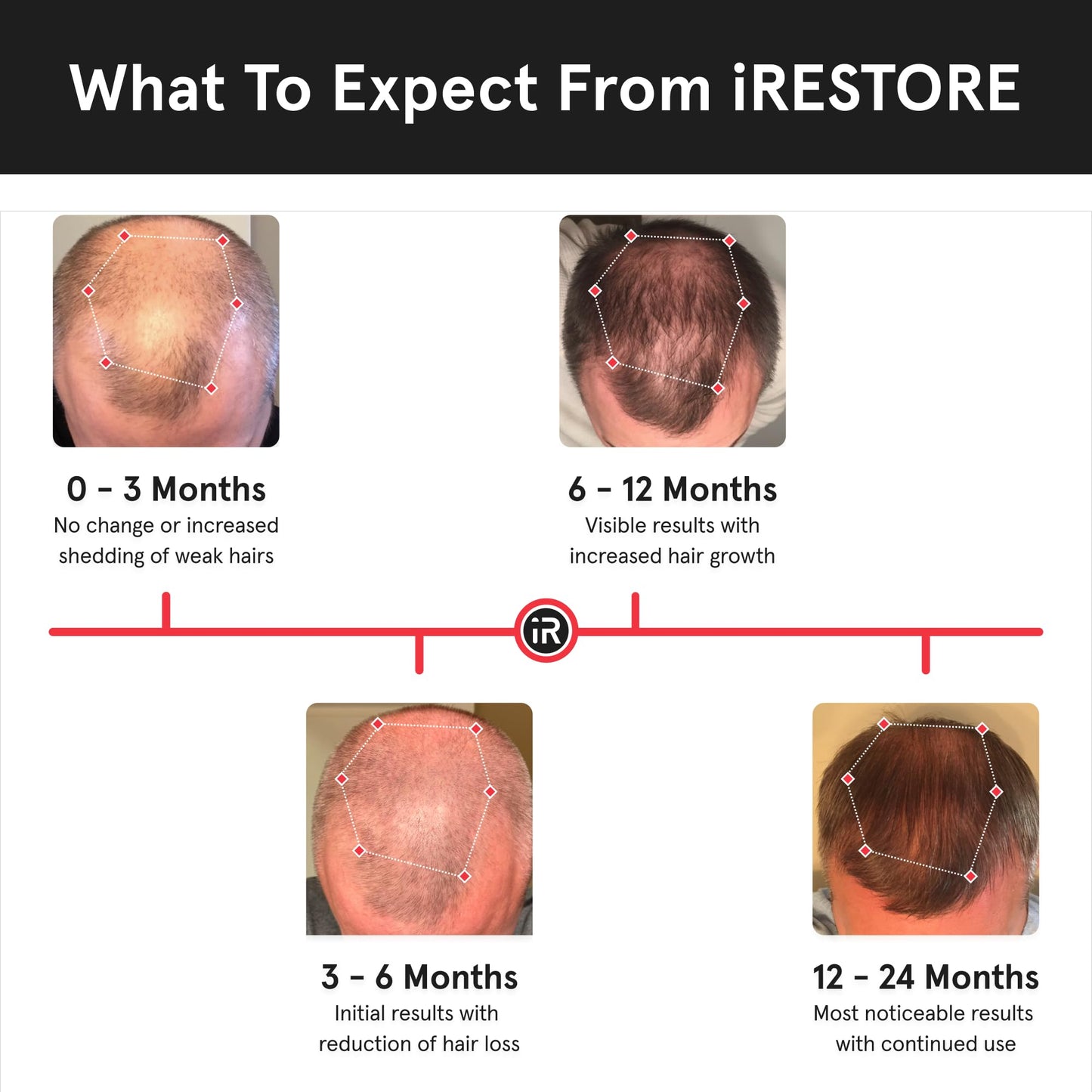 iRestore Essential - Laser Red Light Therapy for Hair Growth - FDA Cleared Hair Loss, Hair Thinning & Alopecia Treatment for Men & Women - Laser Cap for Hair Regrowth Stimulate Denser Fuller Hair - Medaid International