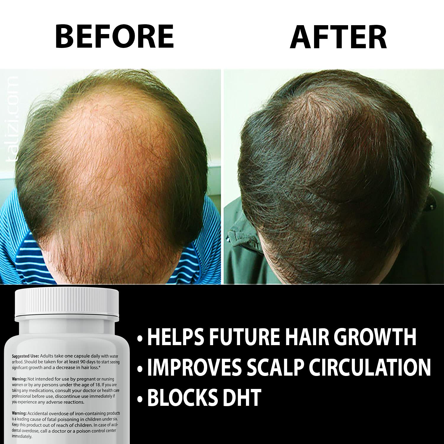 Finanutride Natural DHT Blocker & Hair Growth Capsules - Prevent Hair Loss, Stimulate Follicles, Proprietary Regrowth Treatment - Medaid International