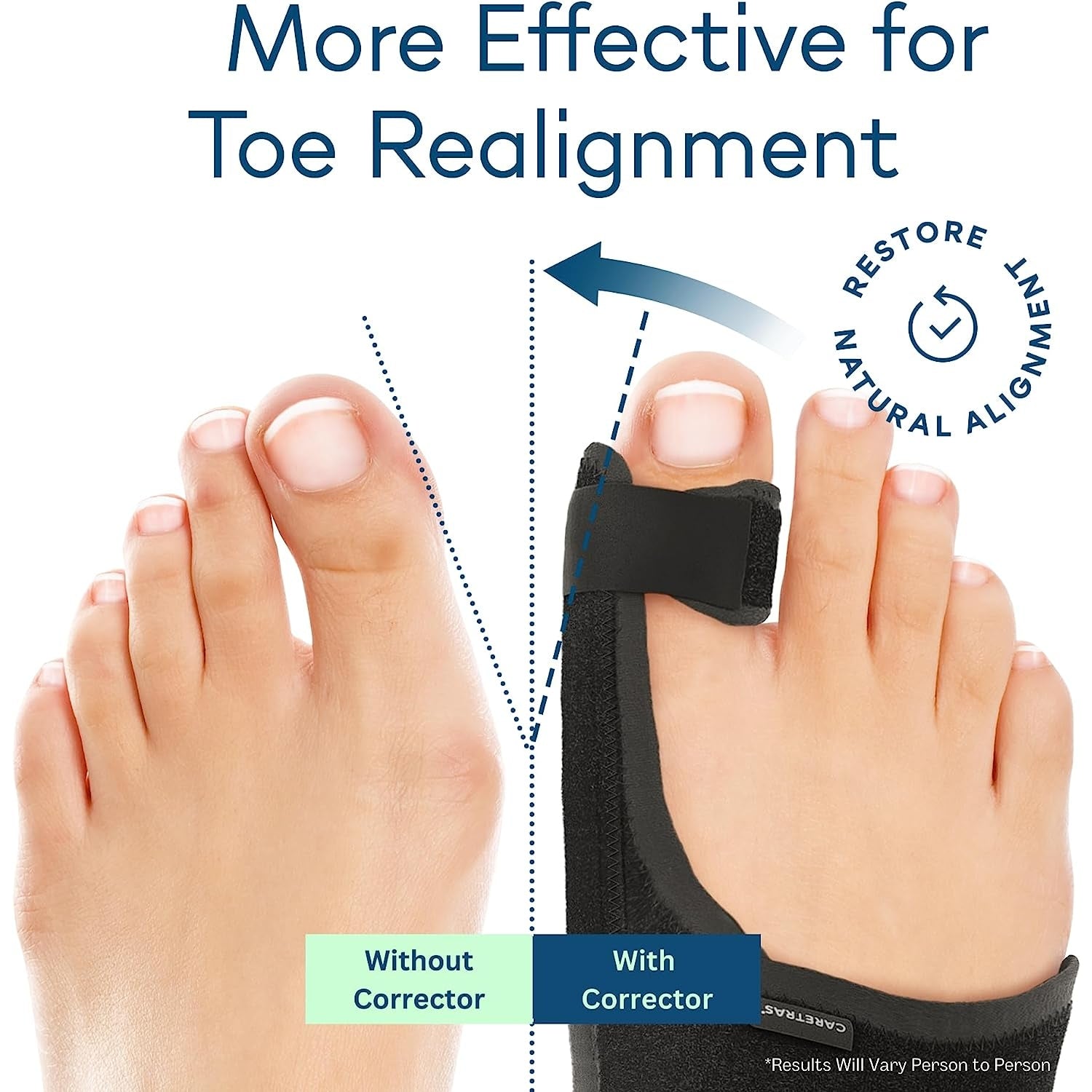 Bunion Corrector Pedimend Pairs Orthotics For Bunions And