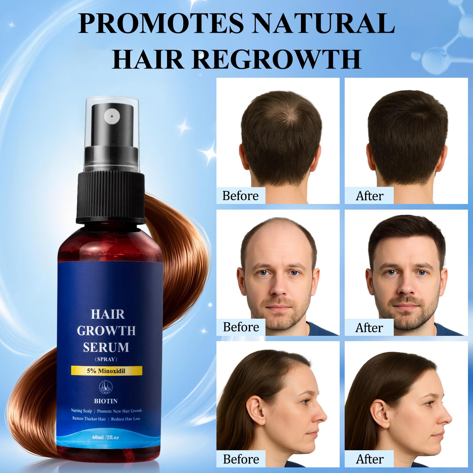 5% Minoxidil Hair Growth Spray - Minoxidil for Men and Women Hair Growth, Hair Regrowth Treatment for Stronger Thicker Hair (60ml) - Medaid International