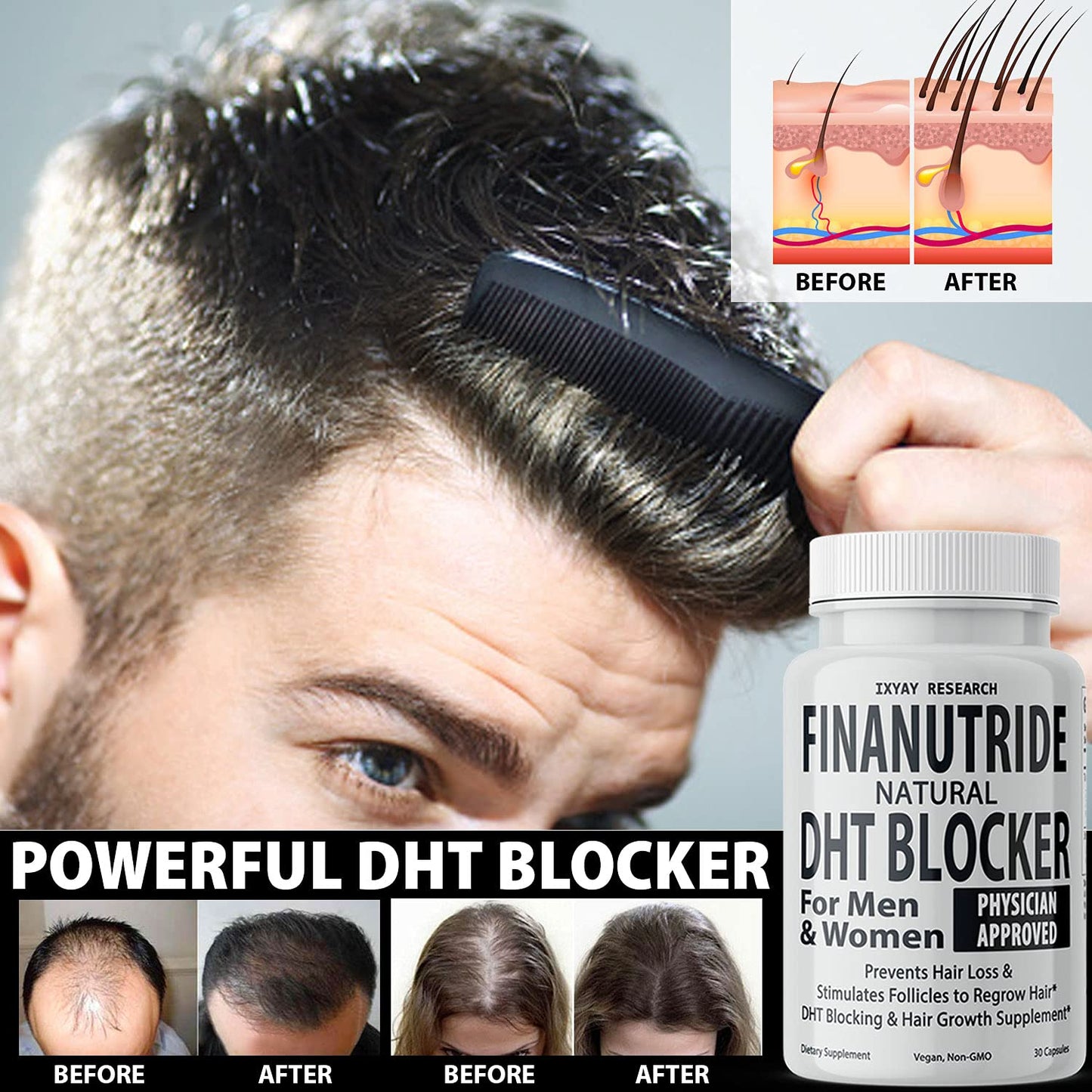 Finanutride Natural DHT Blocker & Hair Growth Capsules - Prevent Hair Loss, Stimulate Follicles, Proprietary Regrowth Treatment - Medaid International