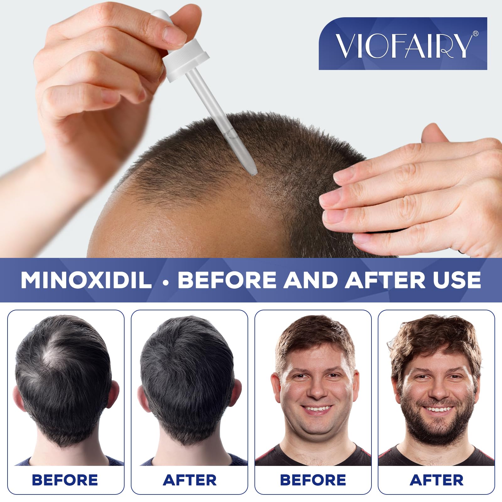 5% Minoxidil for Men and Women, Hair Regrowth Treatment for Thinning Hair and Hair Loss, Topical Solution - 1 Months Supply - Dermatologist recommended (Pack of 1) - Medaid International