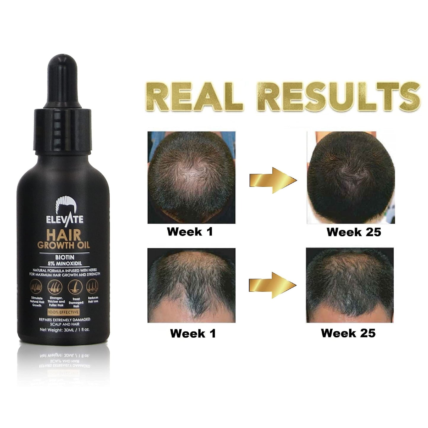 Elevate Hair Regrowth Treatment 5% Minoxidil Solution - Biotin Serum Hair Growth Oil for Men & Women - Thicker Fuller Stronger Hair - Stops Hair Loss & Thinning - Natural Hair Thickening Treatment 1oz - Medaid International