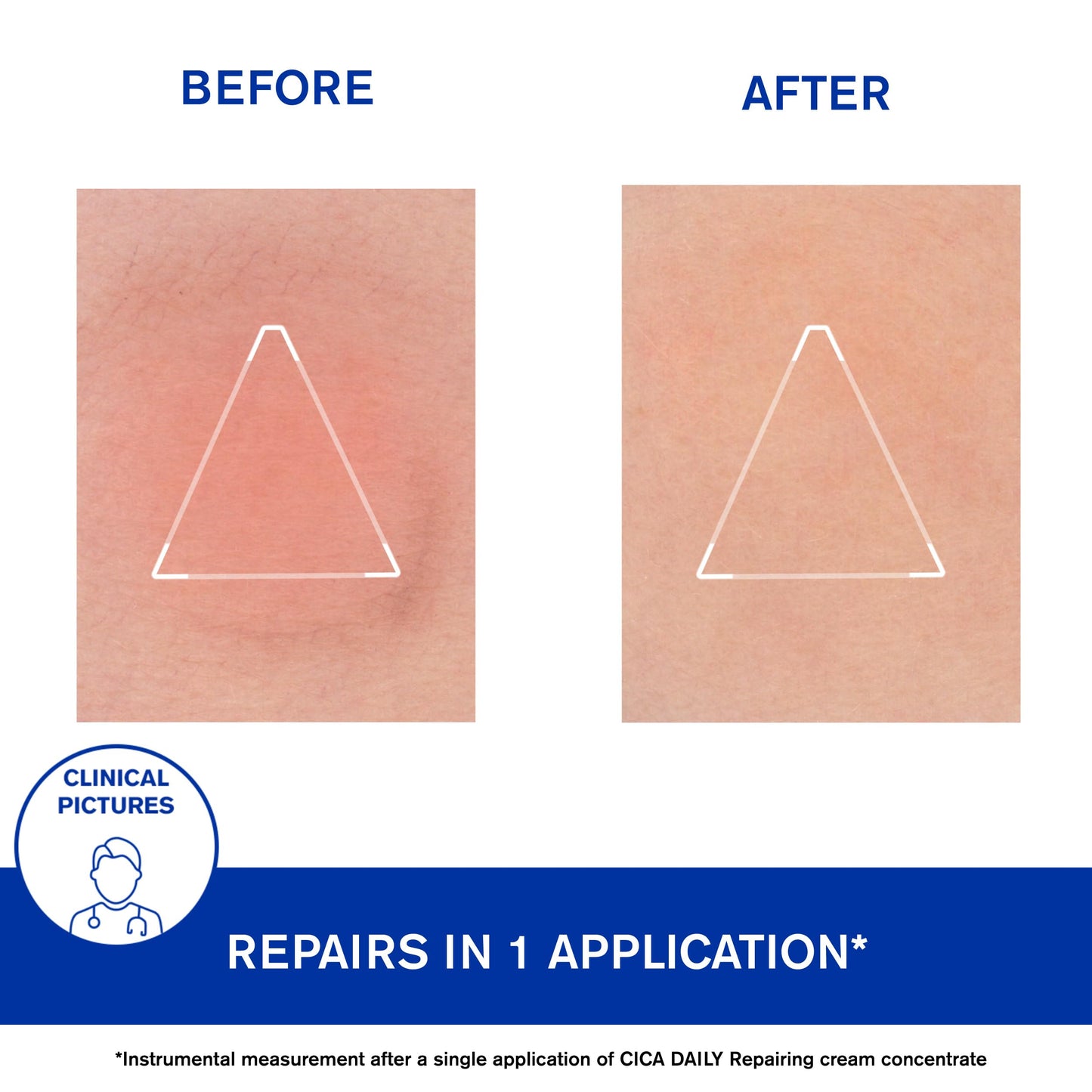 URIAGE Cica-Daily Intense Repairing Serum | Made With Prebiotic, Hyaluronic Acid & Centella Asiatica, Boosts Skin Repair, Paraben & Fragrance-free, Non-Comedogenic, 30 mL / 1.01 oz - Medaid International