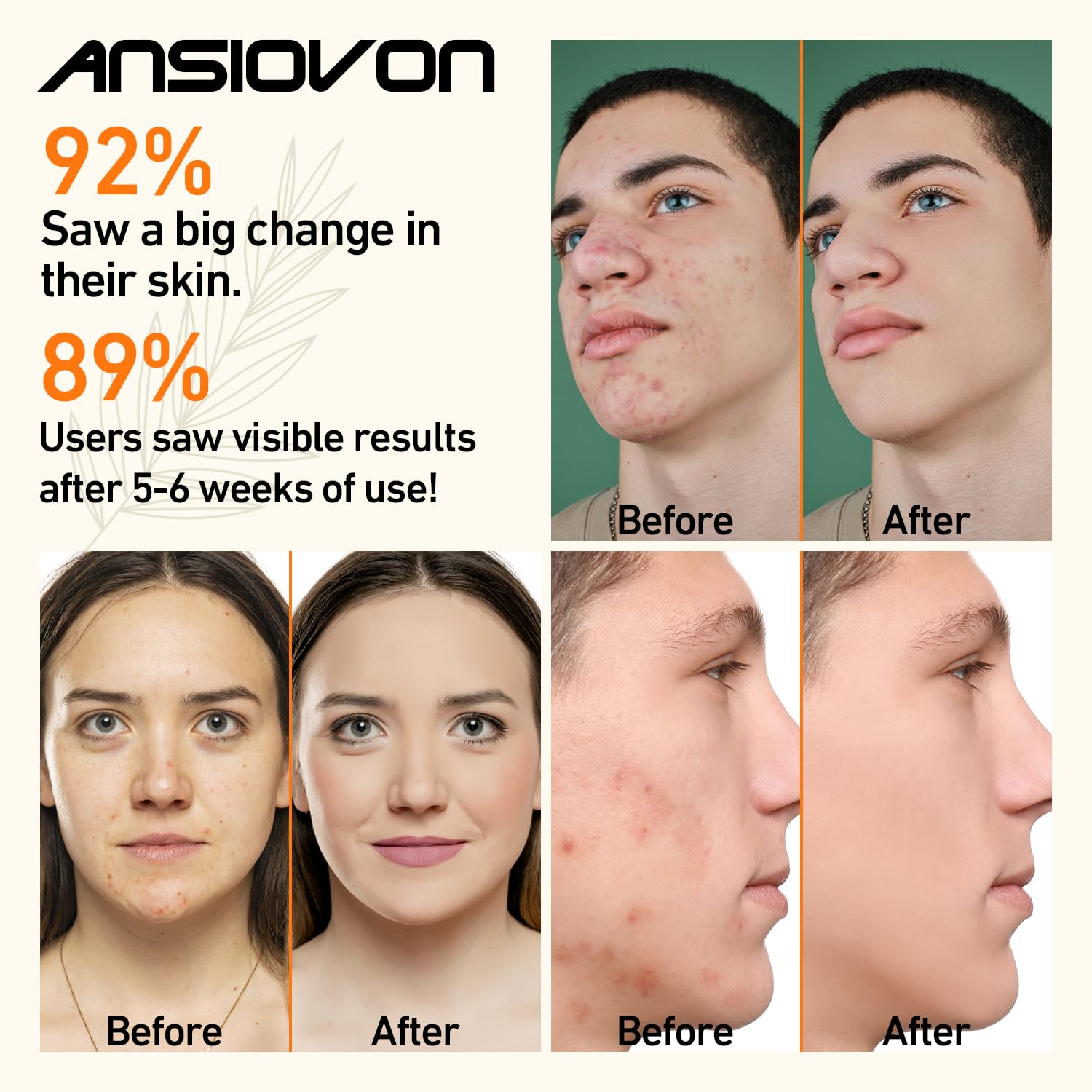 ANSIOVON Blue Light Therapy Device for Acne Spot Treatment - LED Acne Blue Light Therapy Wand for Face - Medaid International