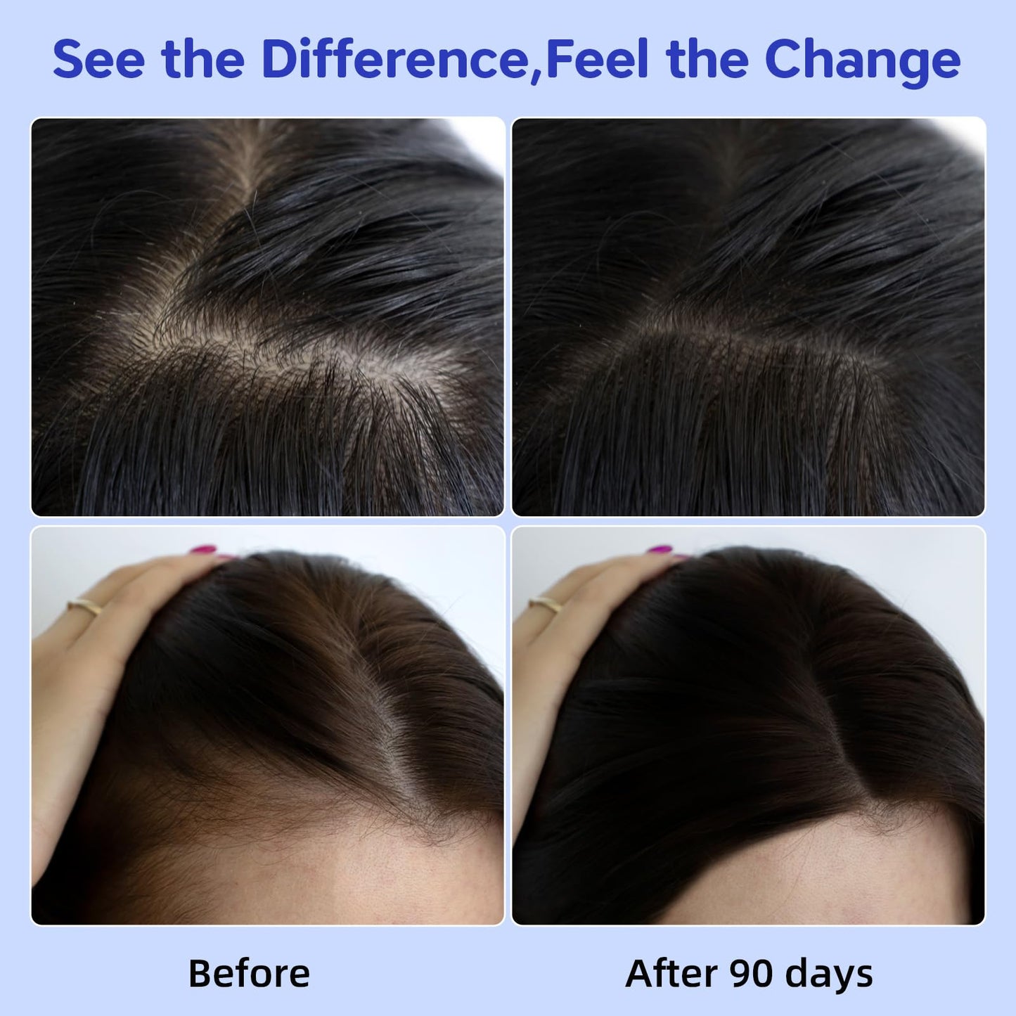 Hair Growth Serum with Rosemary Oil & Saw Palmetto - 100% Natural Plant-Based Formula to Stimulate Follicles, Revive Roots for Visibly Thicker Fuller Hair, Reduce Shedding and Loss For Men & Women - Medaid International