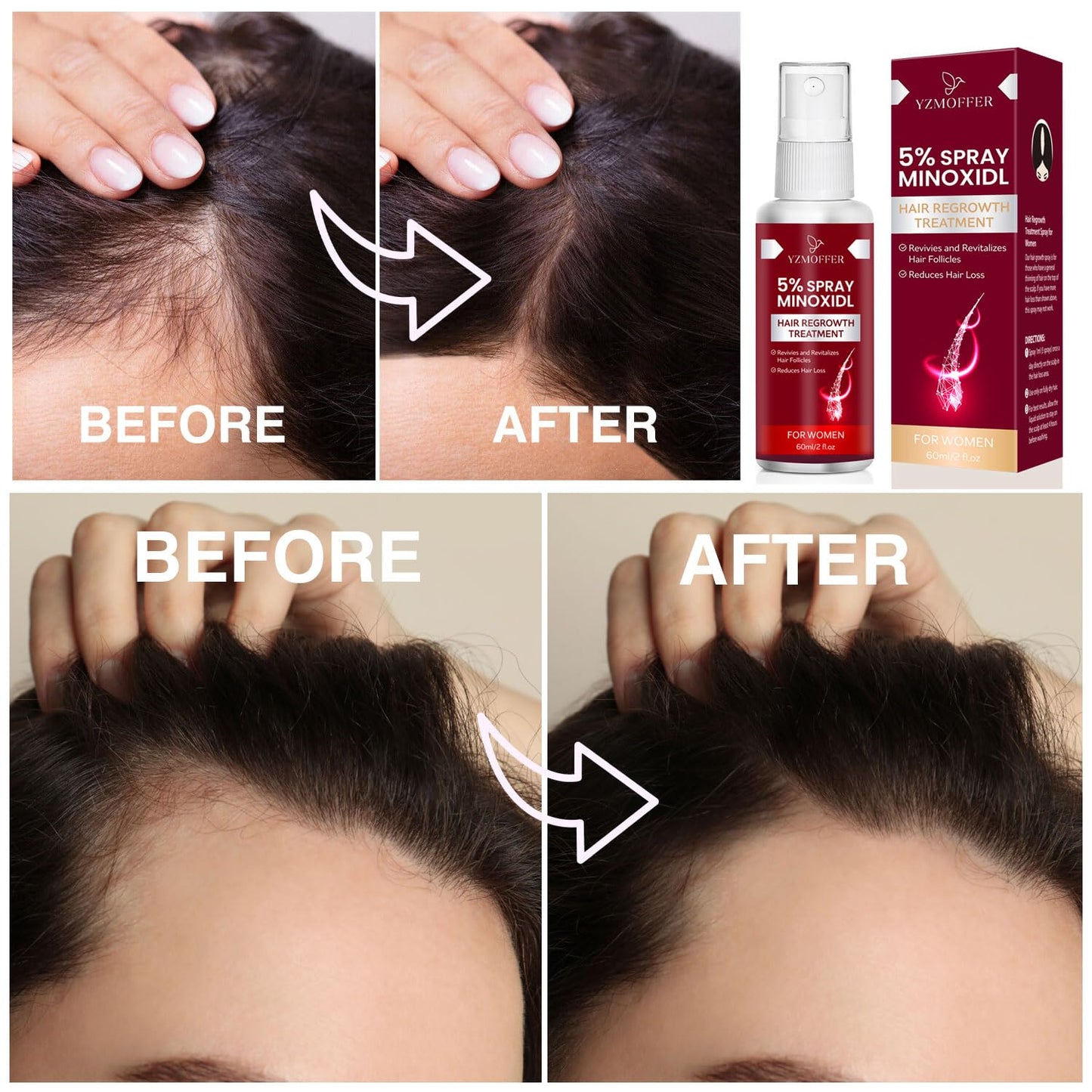 5% Minoxidil for Women Hair Growth: Hair Loss Treatment for Hair Thinning and Hair Loss to Get Thicker and Fuller Hair, 60ML - Medaid International
