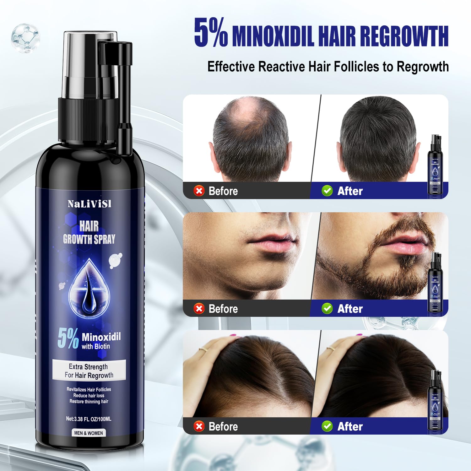 5% Minoxidil For Men And Women Hair Growth Spray - Hims Hair Regrowth Treatment For Stronger Thicker Longer Hair 2-3 Month Supply 100ml(3.38oz) - Medaid International