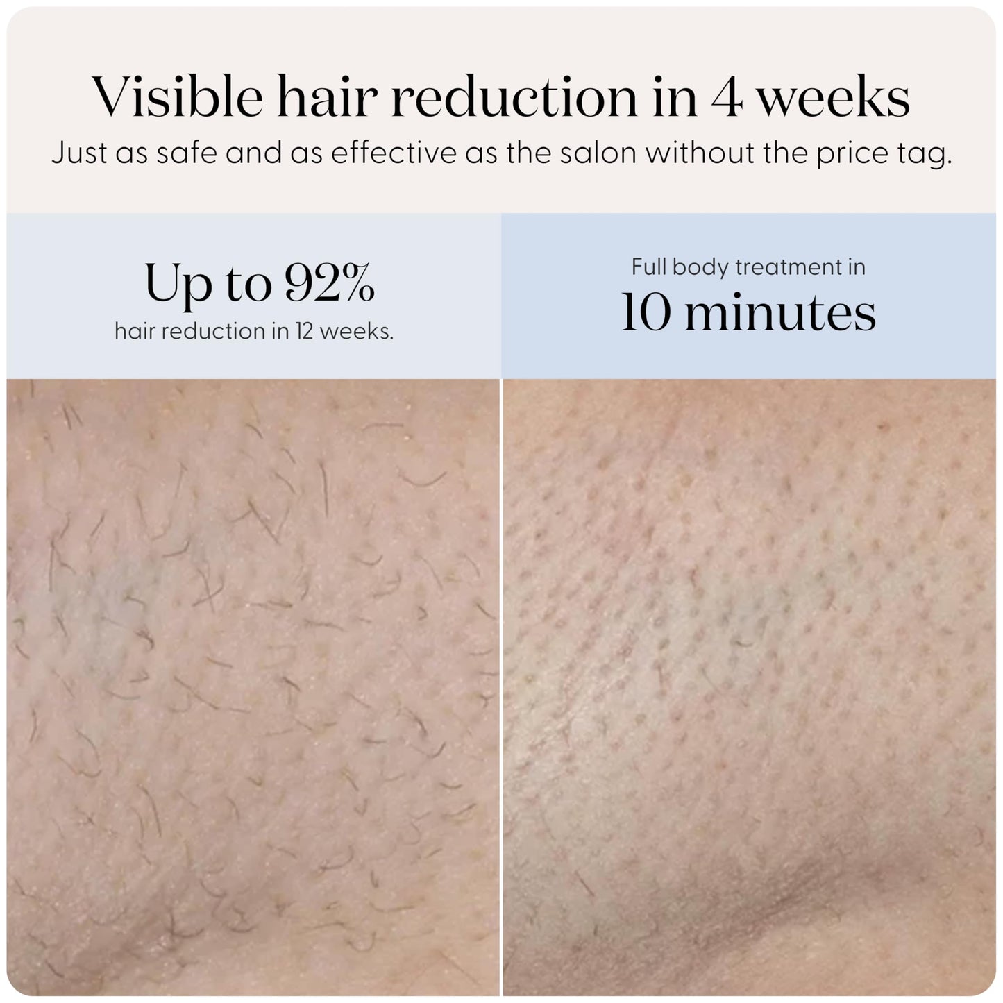 SmoothSkin Pure Mini Lite IPL Lilac Hair Removal Device – Compact at-Home Laser Hair Removal for Women, Safe for Face & Body, Permanent Hair Reduction, Gentle & Painless, Salon-Quality Results - Medaid International