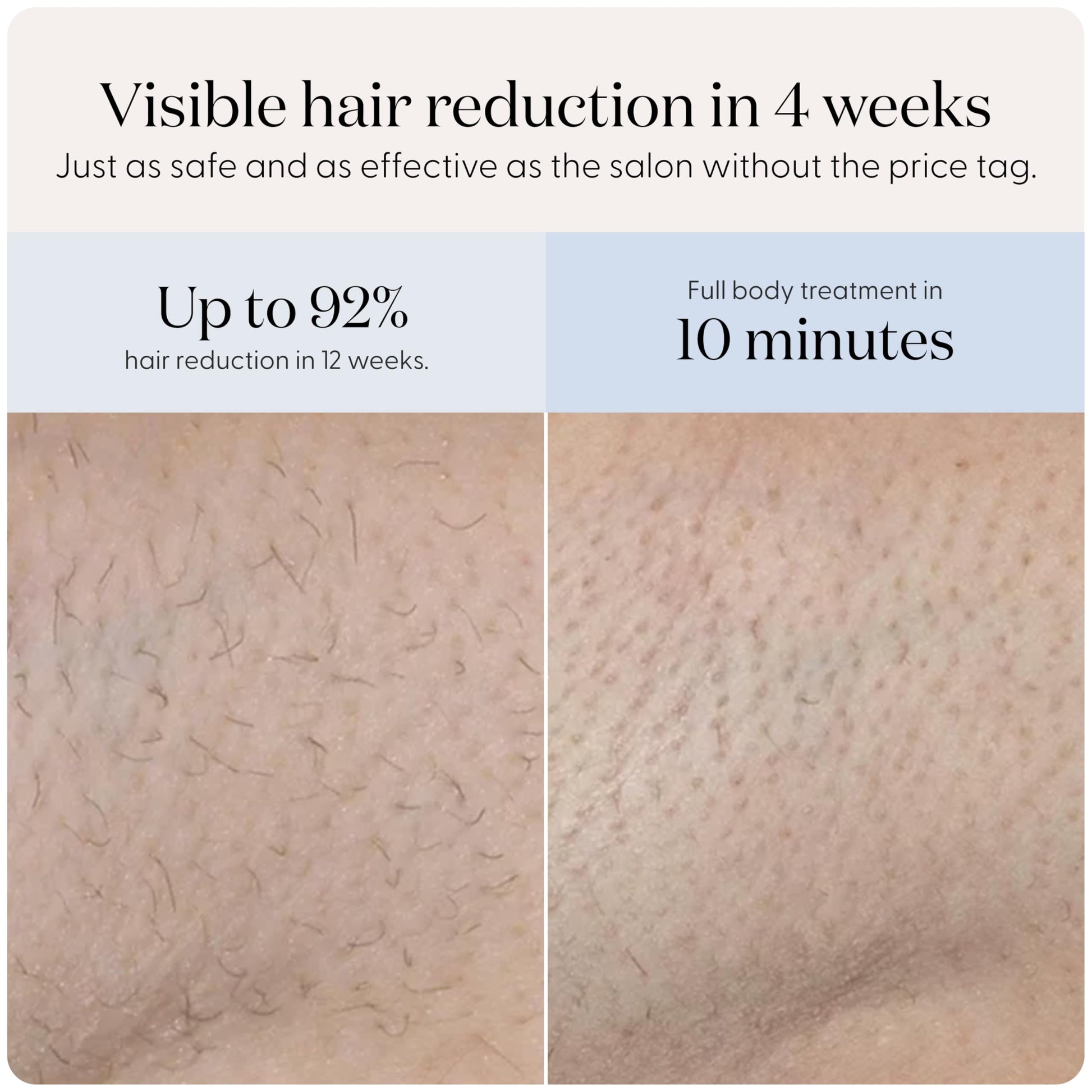 SmoothSkin Pure Mini Lite IPL Lilac Hair Removal Device – Compact at-Home Laser Hair Removal for Women, Safe for Face & Body, Permanent Hair Reduction, Gentle & Painless, Salon-Quality Results - Medaid International