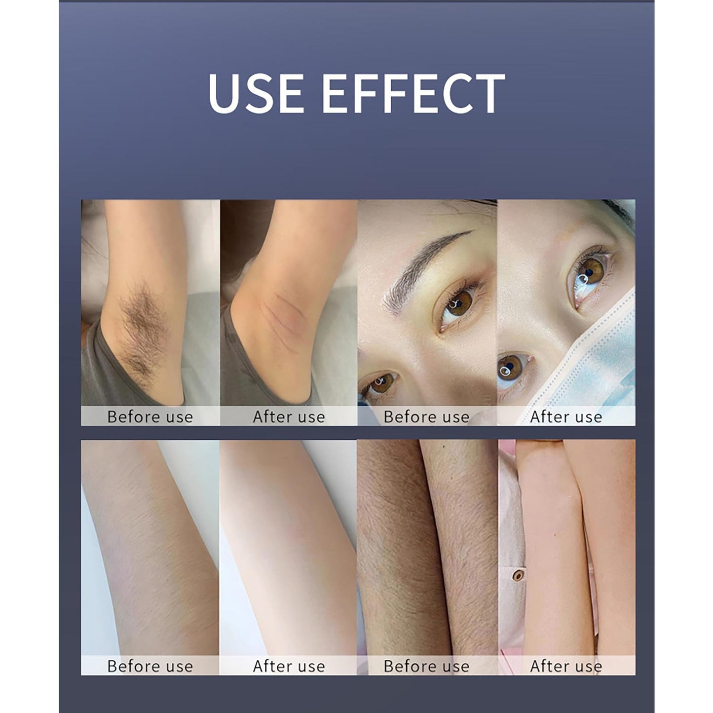 FXNFXLA Hair Removal Device, 755nm 808nm 1064nm Diode Laser Hair Removal Laser Device, Hair Removal for Women and Men - Medaid International