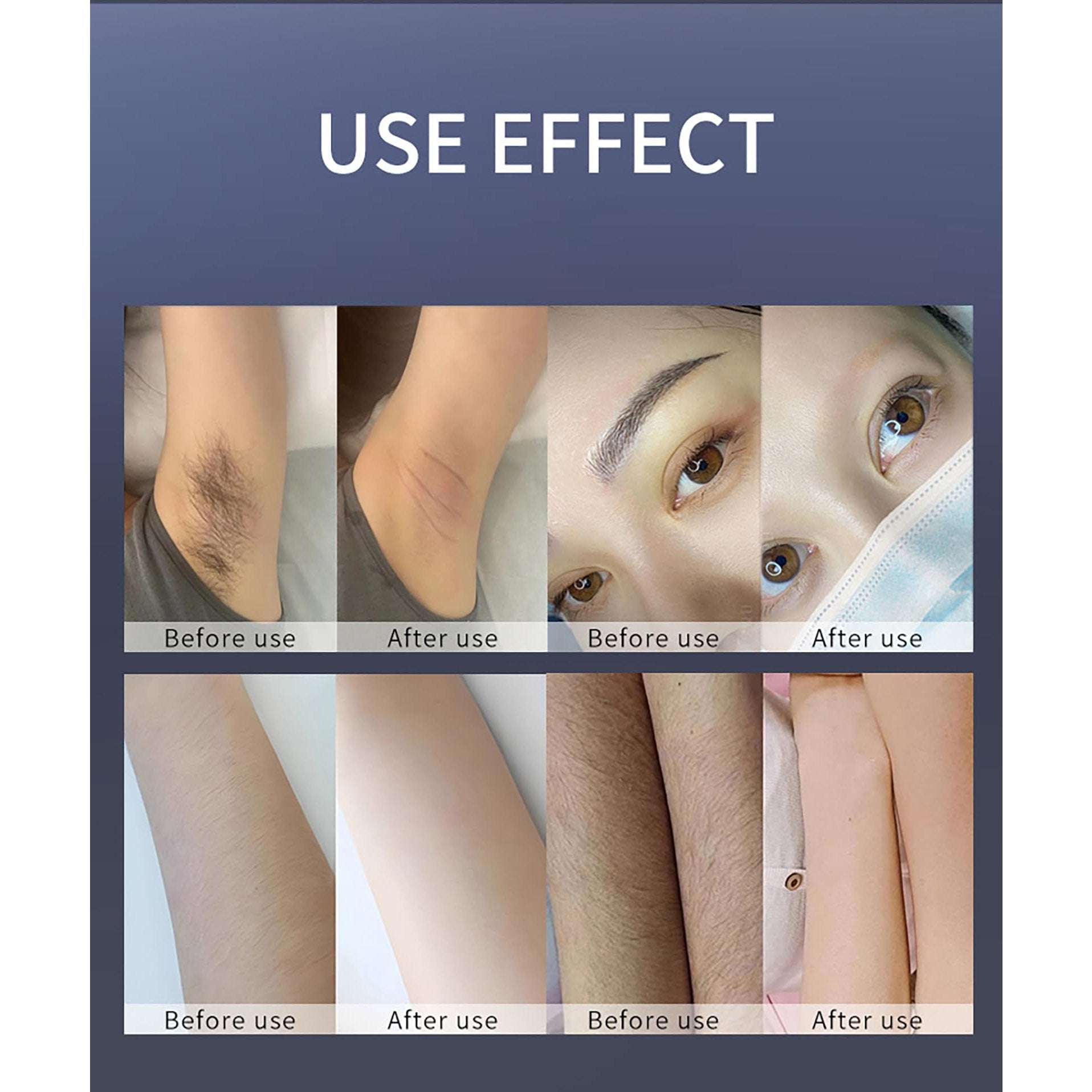 FXNFXLA Hair Removal Device, 755nm 808nm 1064nm Diode Laser Hair Removal Laser Device, Hair Removal for Women and Men - Medaid International