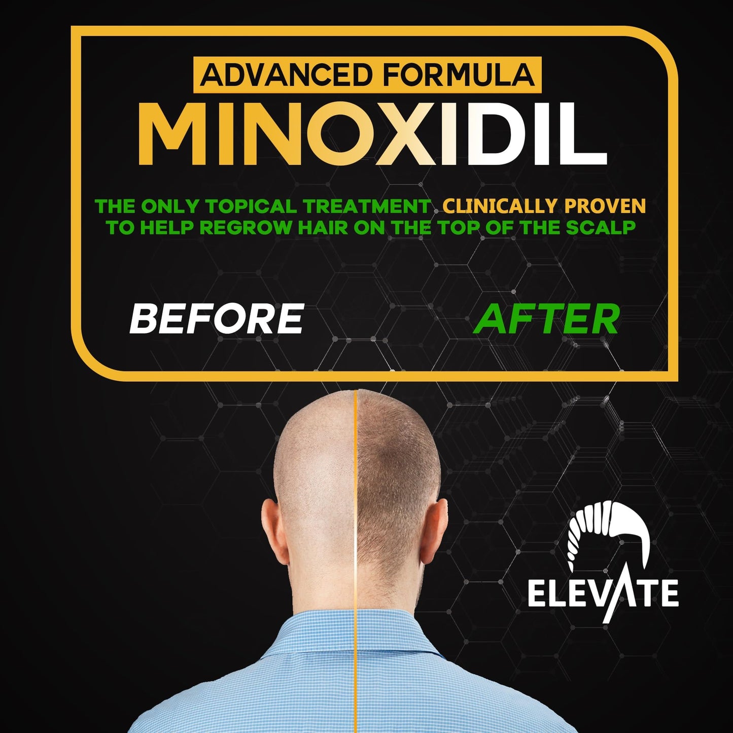 Elevate Hair Regrowth Treatment 5% Minoxidil Spray - Extra Strength Formula Professional Treatment for Hair Loss and Thinning for Regrowth - Stimulate Follicles for Men and Women 1 Month Supply - Medaid International