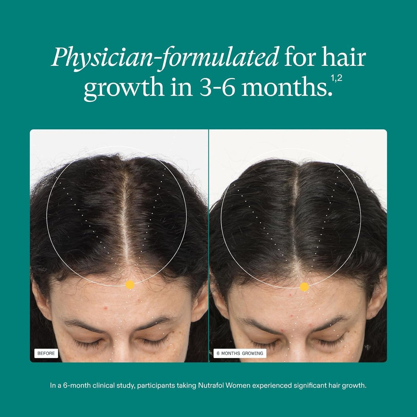 Nutrafol Women's Hair Growth Supplements, Ages 18-44, Clinically Proven for Visibly Thicker and Stronger Hair, Dermatologist Recommended - 1 Month Supply - Medaid International